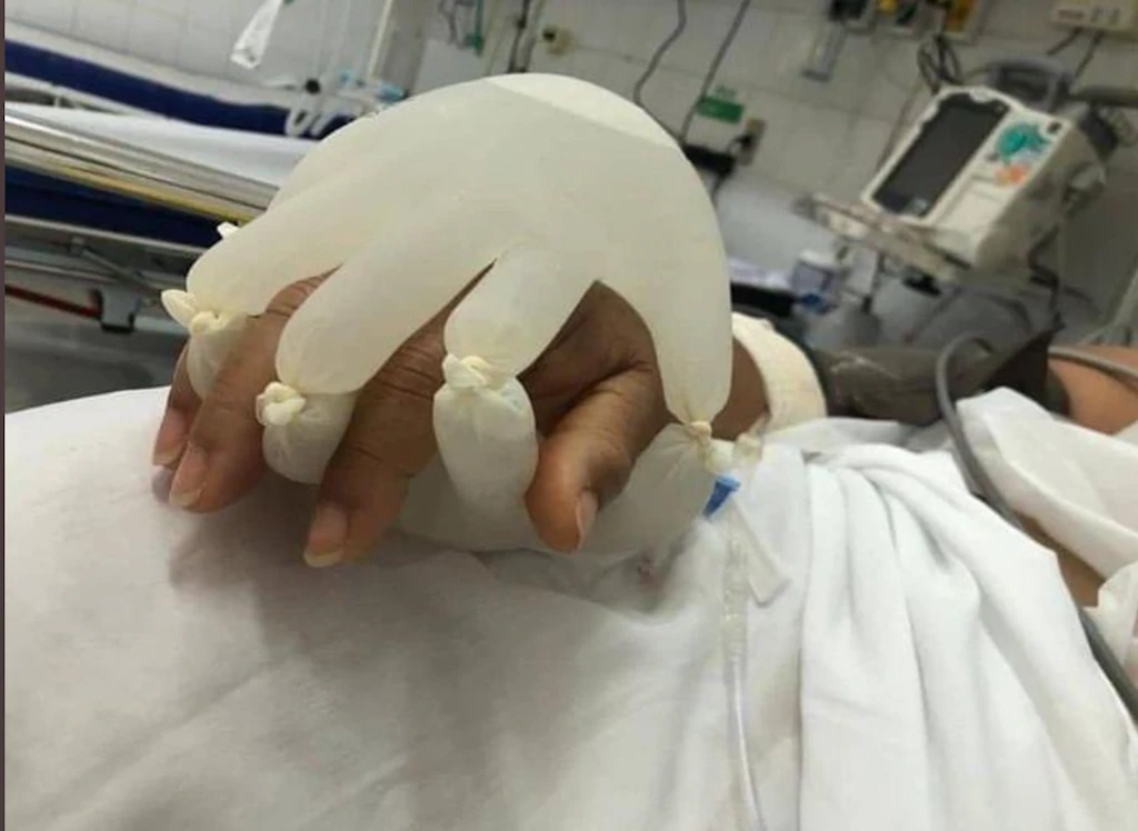 Virales Foto: Corona-Patienten halten Plastikhandschuhe gegen Einsamkeit