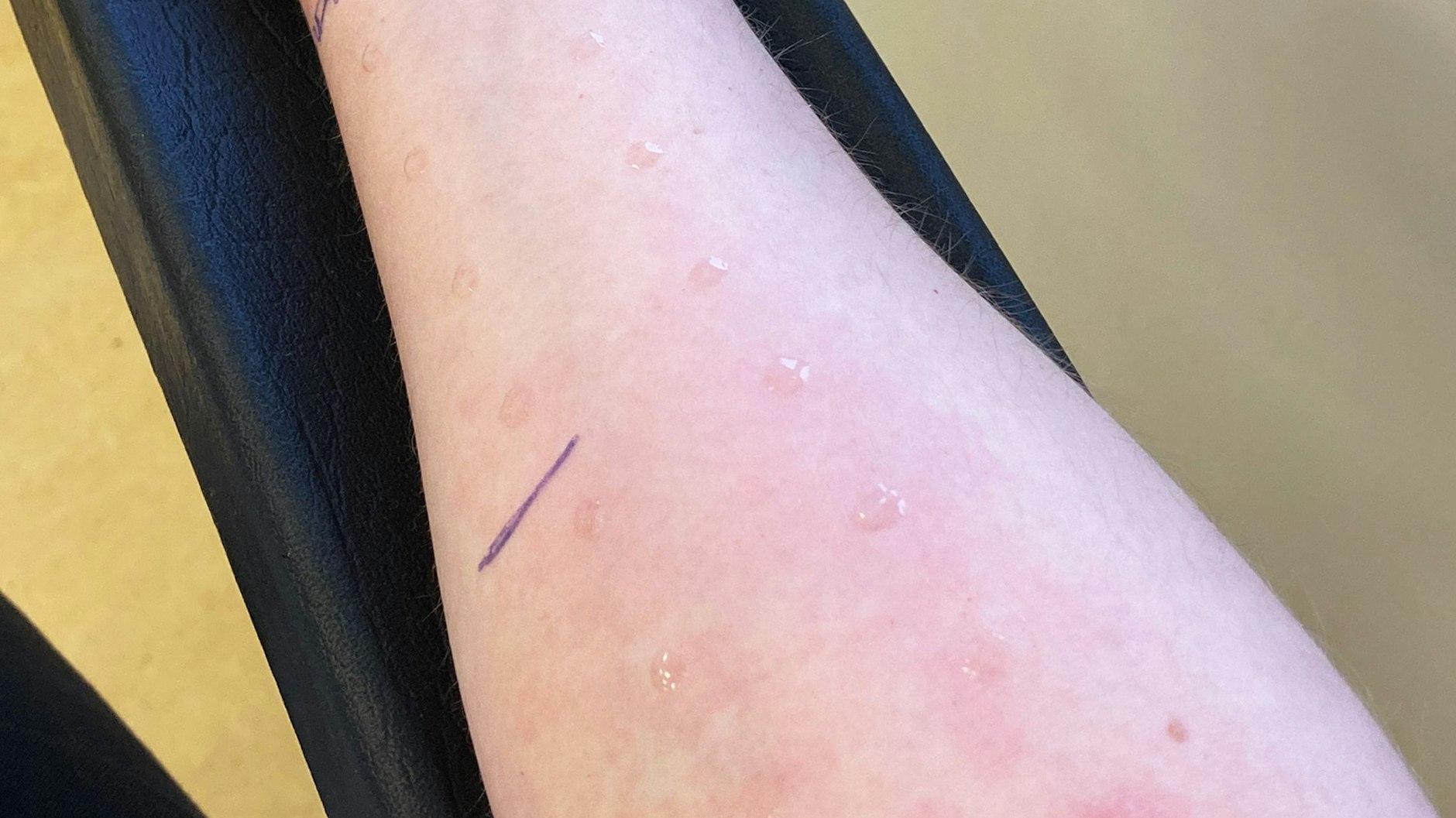 Bei einem Pricktest wird ermittelt, wie die Haut auf bestimmte Allergene reagiert.