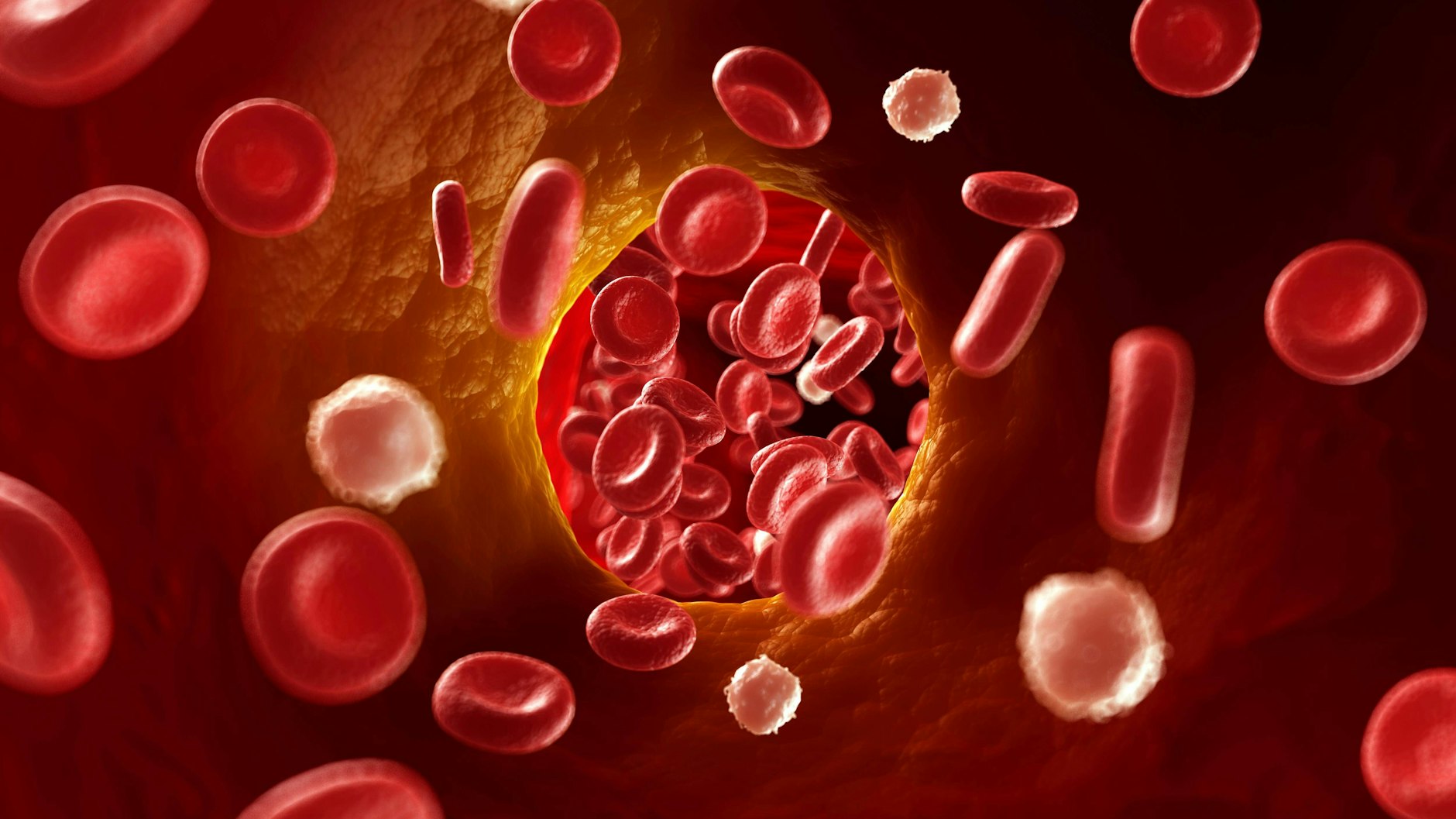 Eine Sinusvenenthrombose ist der Verschluss einer großen Vene im Gehirn durch ein Blutgerinnsel.&nbsp;