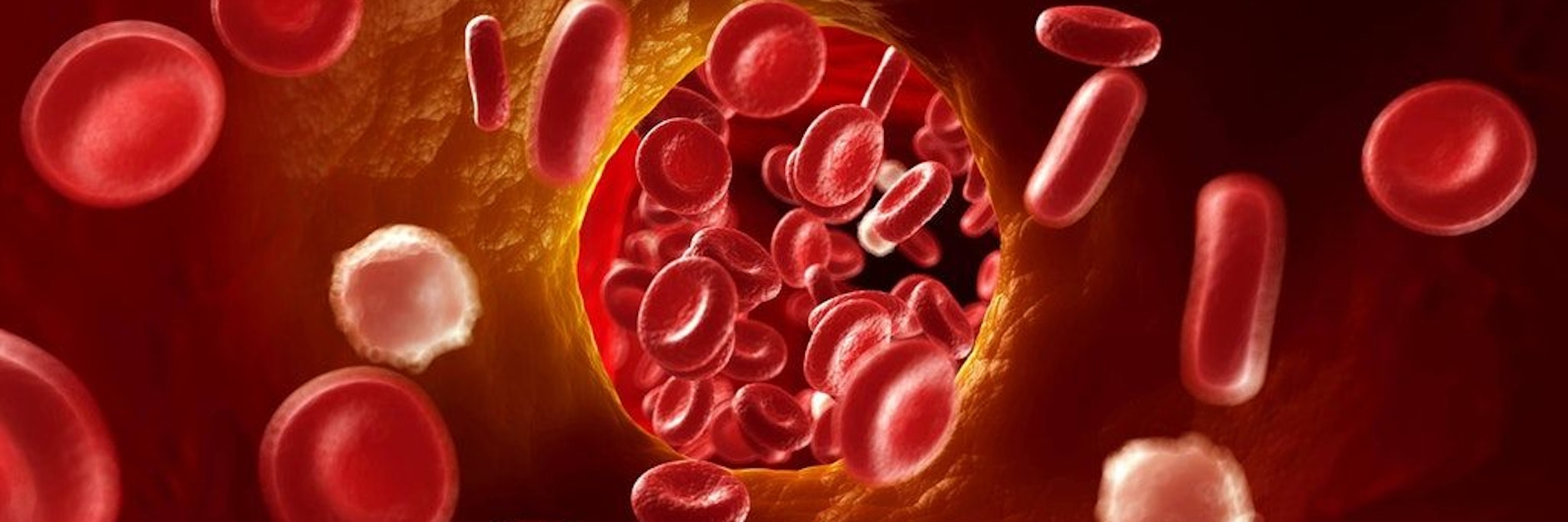 Eine Sinusthrombose ist der Verschluss einer großen Vene im Gehirn durch ein Blutgerinnsel. 