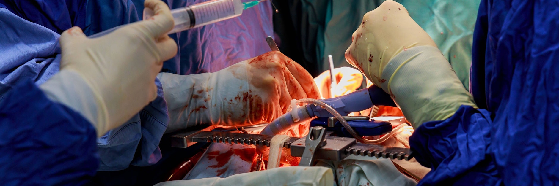 Ärzte operieren einen Patienten am Herzen (Symbolbild).