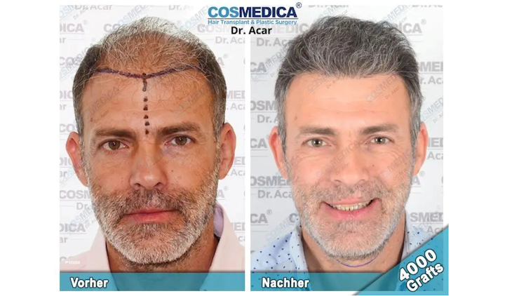 Haartransplantation Vorher Nachher In Der Türkei Das Kann Sich Sehen