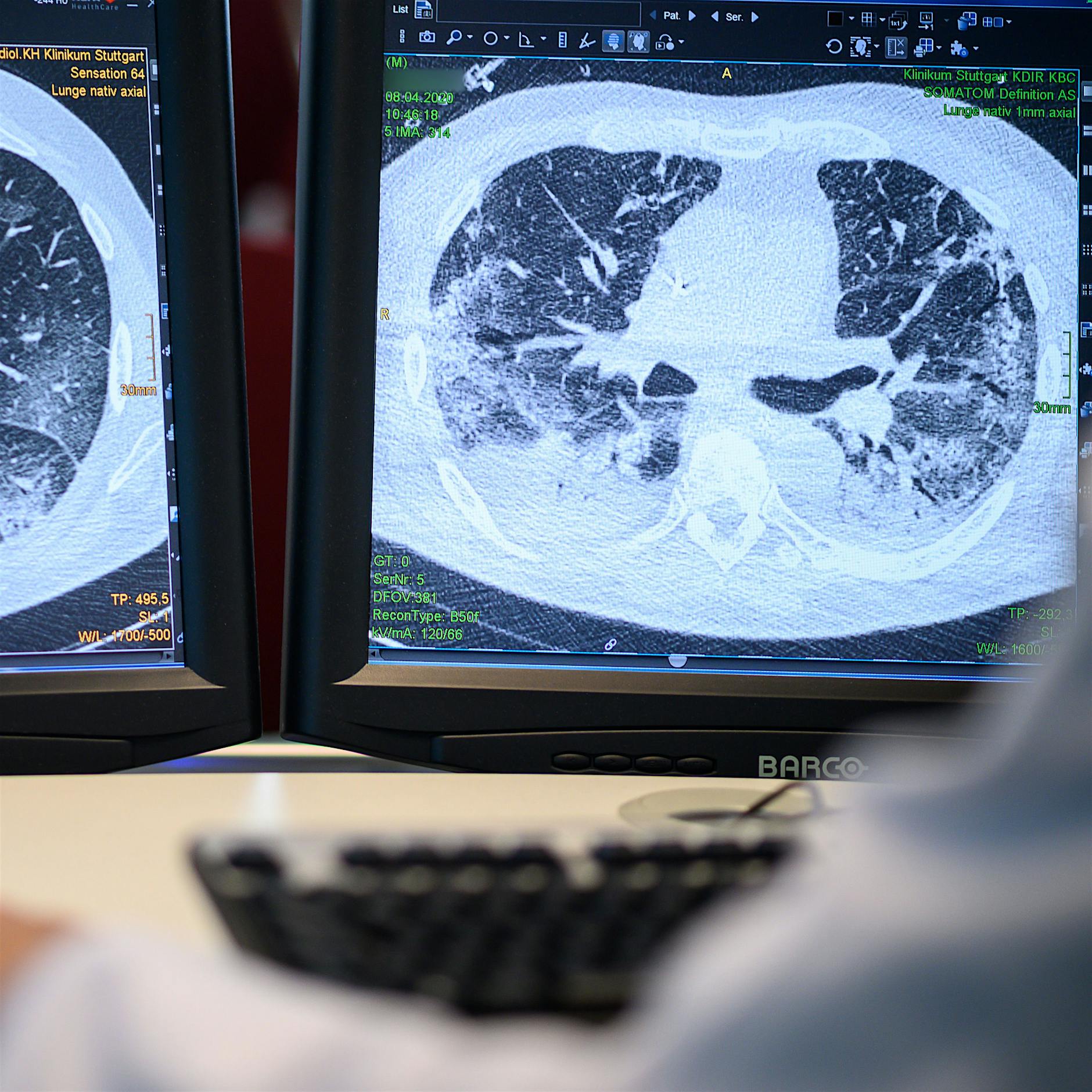 Neue Studie: Sterberisiko nach Corona-Infektion monatelang erhöht