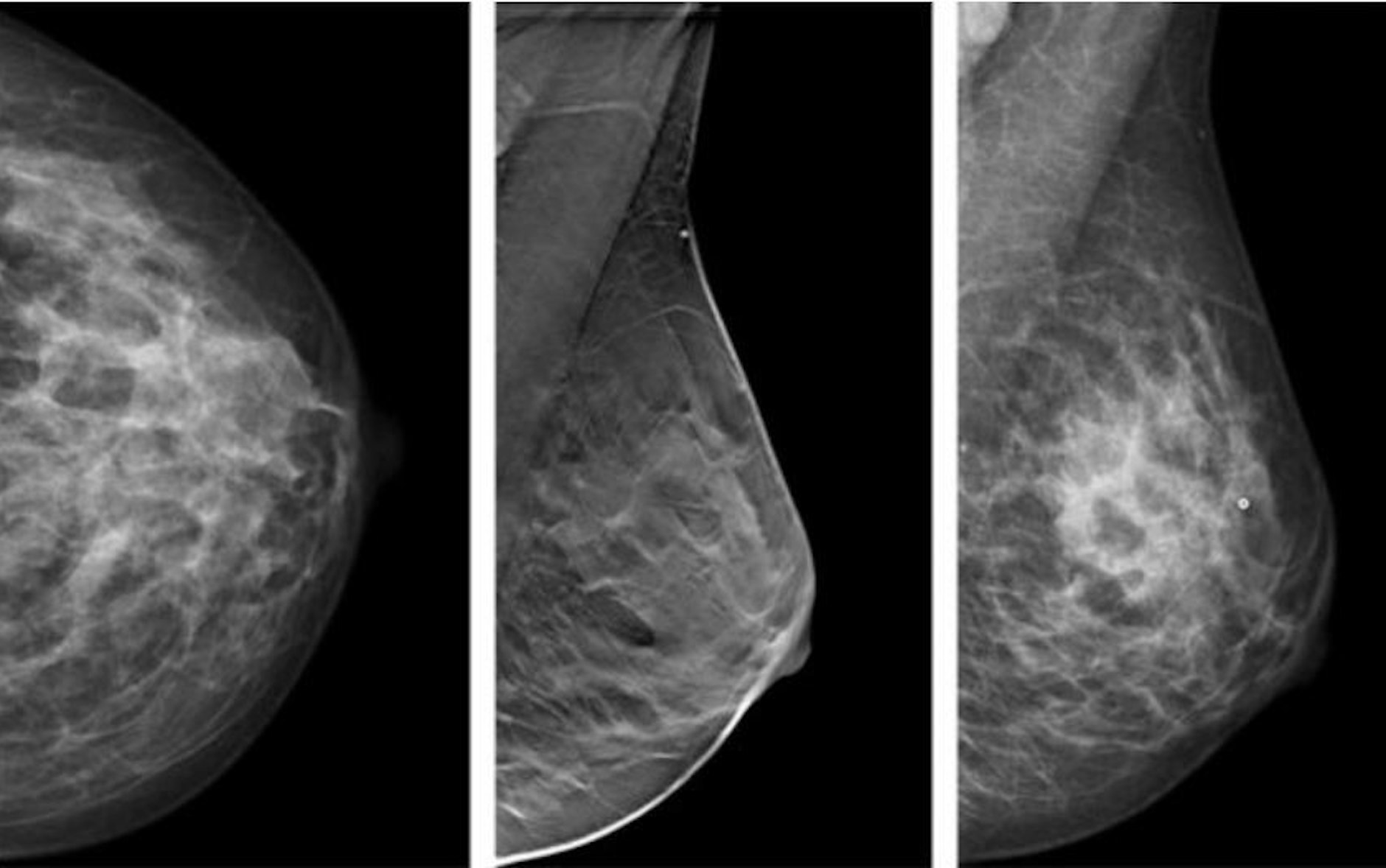 Radiologie-Befund einer 43-jährige Frau mit Mammakarzinom.&nbsp;In Deutschland erkranken etwa 70.000 Frauen im Jahr an Brustkrebs.