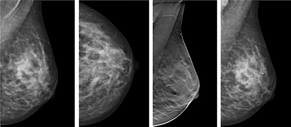 Radiologie-Befund einer 43-jährige Frau mit Mammakarzinom.&nbsp;In Deutschland erkranken etwa 70.000 Frauen im Jahr an Brustkrebs.