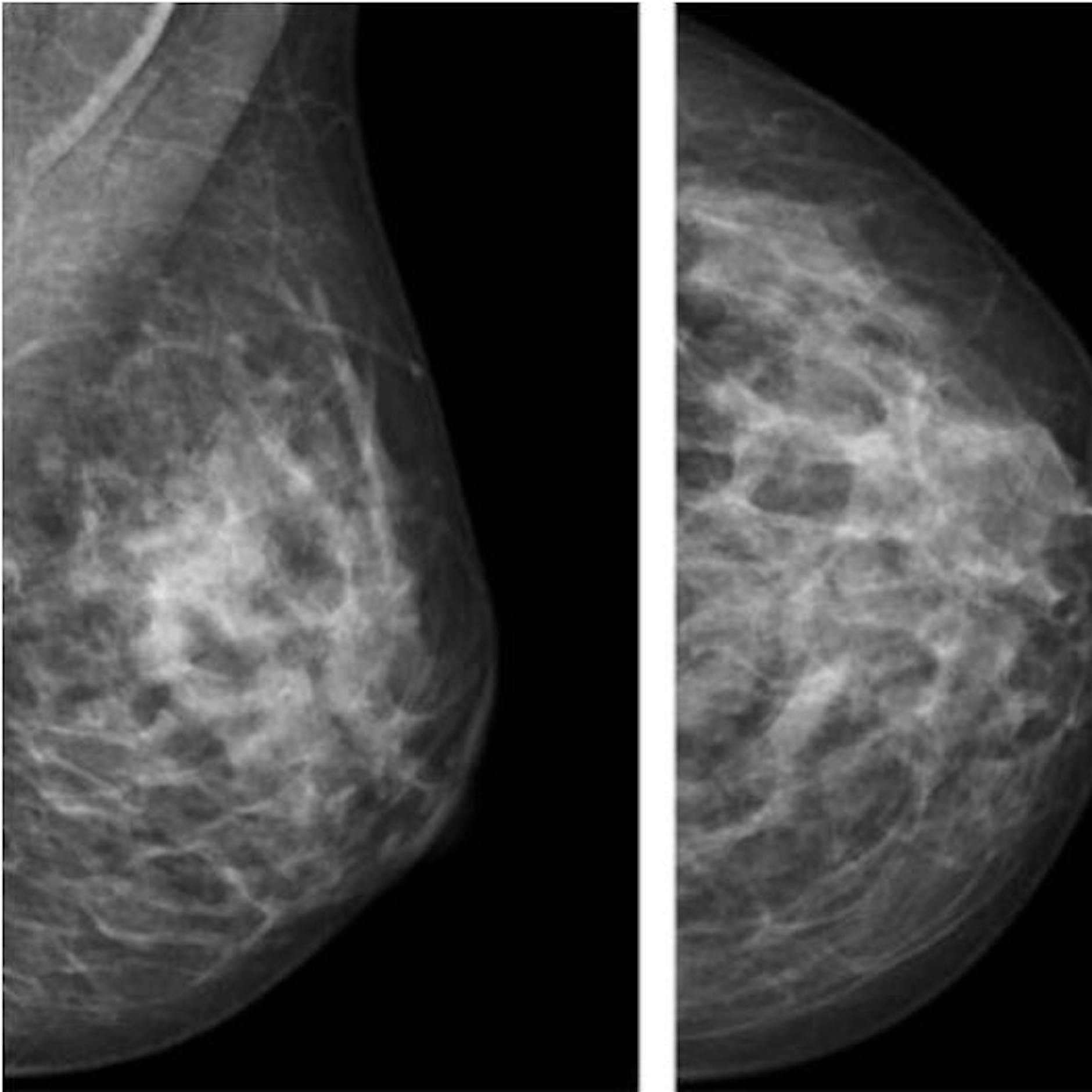 Brustkrebs: Welches Verfahren ist am besten zur Früherkennung geeignet?