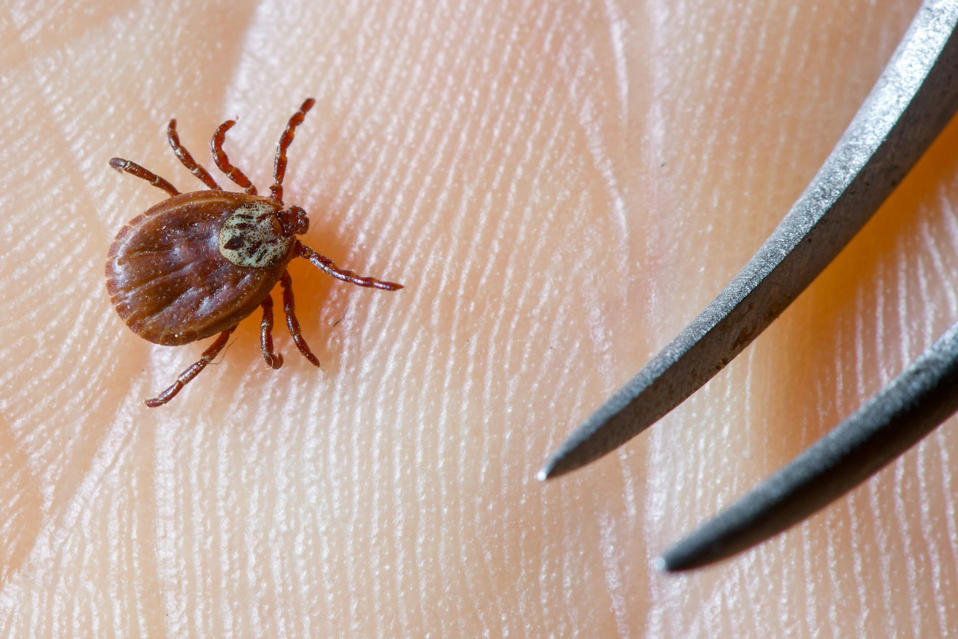 Mit einer Pinzette lässt sich die Zecke gut aus der Haut ziehen – wenn man weiß, wie.