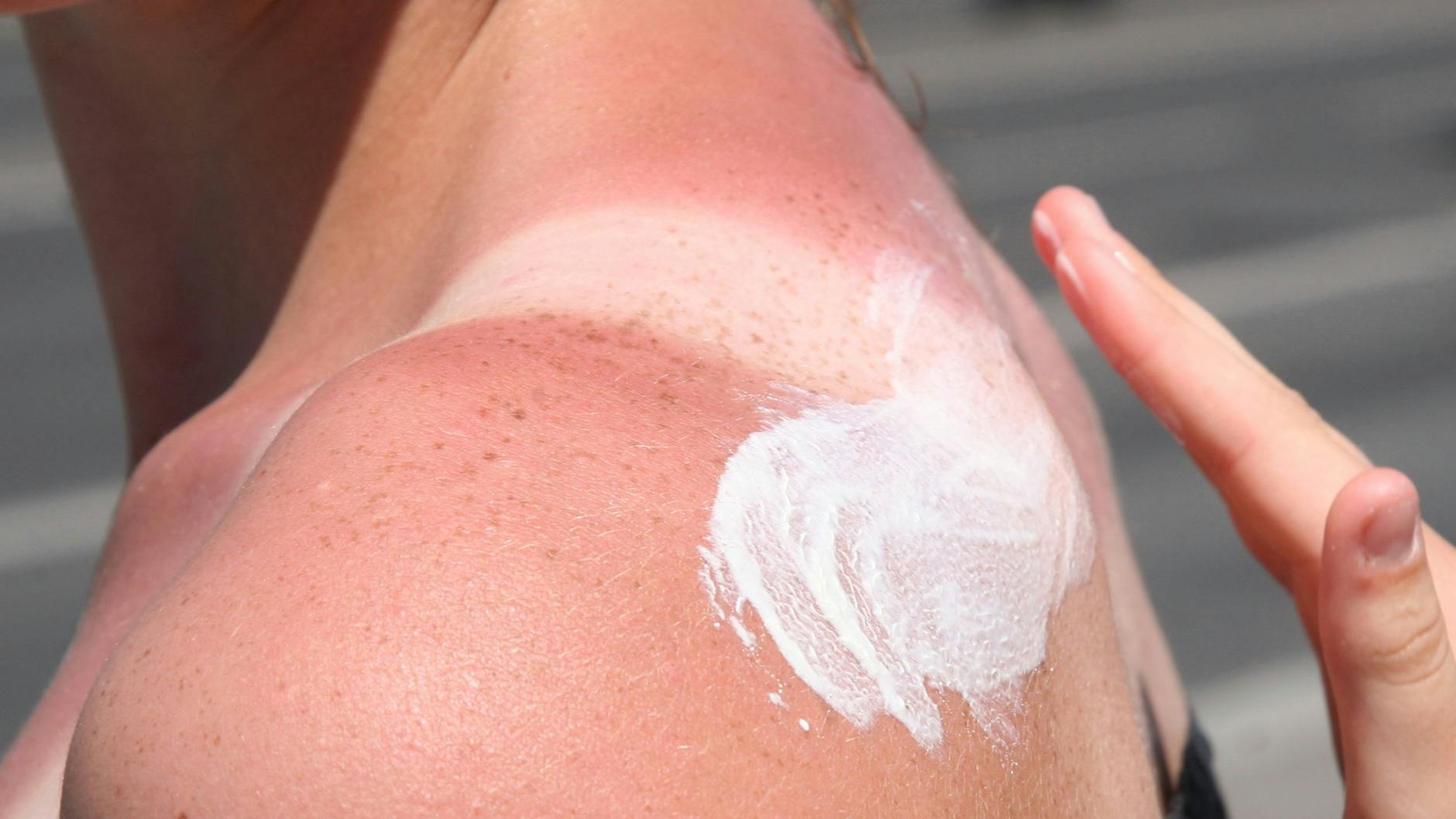 Hier kommt die Sonnencreme zu spät, die Haut ist schon verbrannt. Was hilft nun noch? 