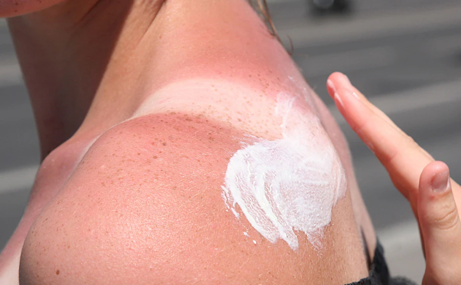 Hier kommt die Sonnencreme zu spät, die Haut ist schon verbrannt. Was hilft nun noch?&nbsp;