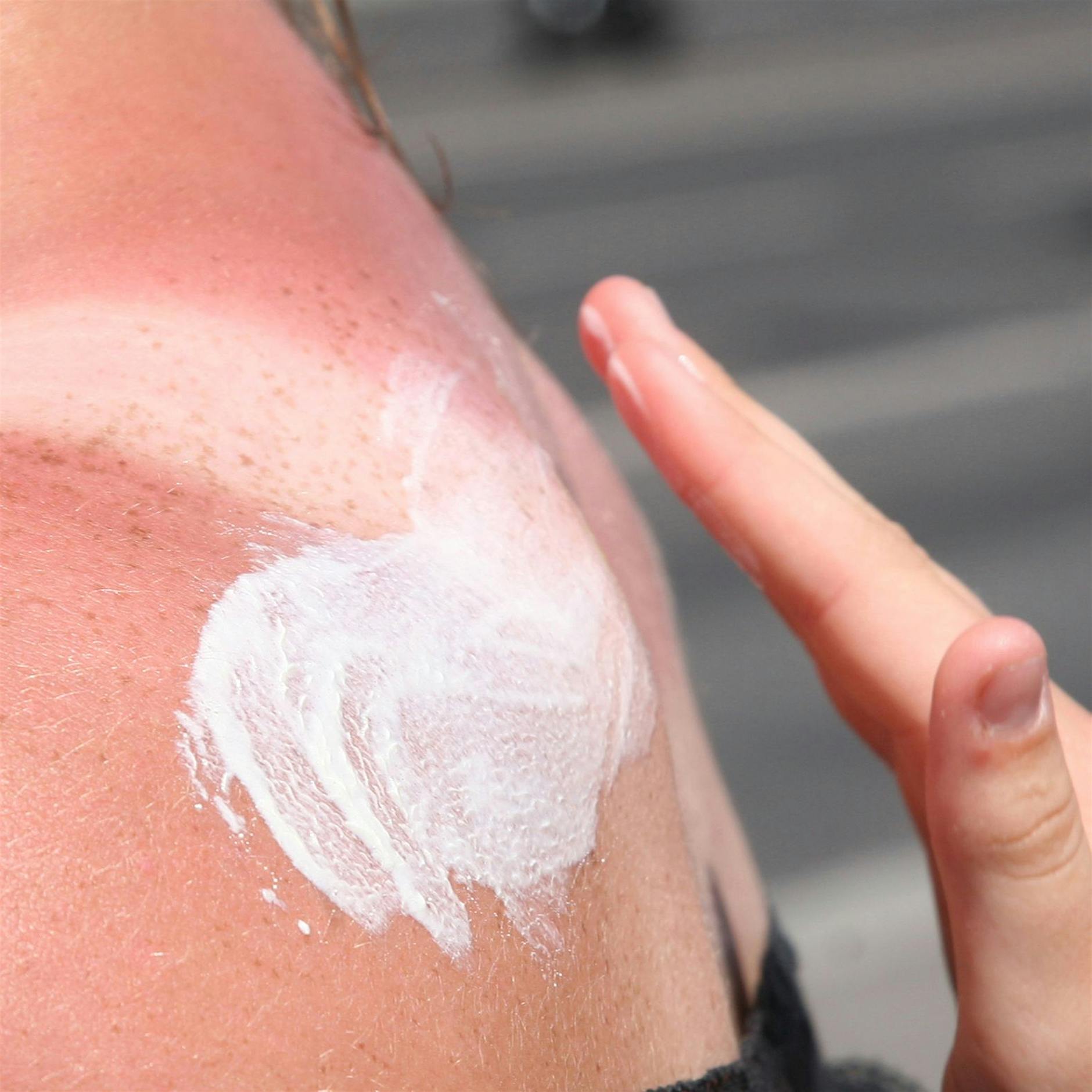 Was hilft bei Sonnenbrand? Experte gibt Tipps