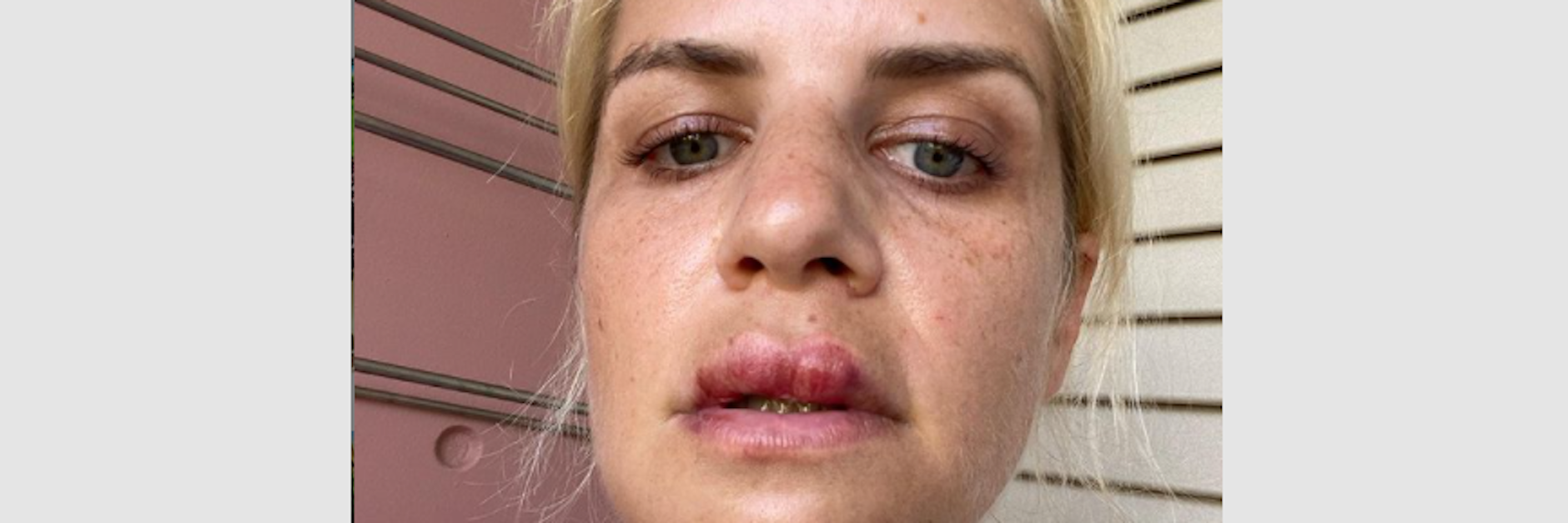 Susan Sideropoulos mit geschwollener Lippe.