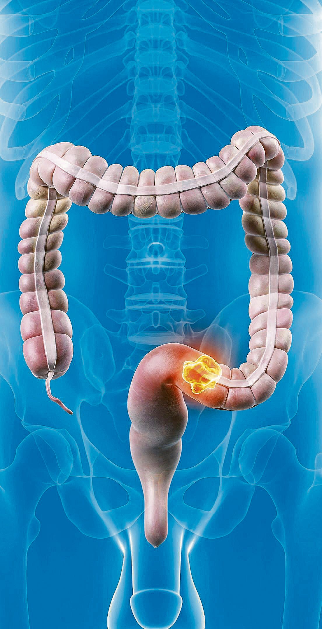 Darmkrebs-Diagnose: Was bedeutet das für mein weiteres Leben?