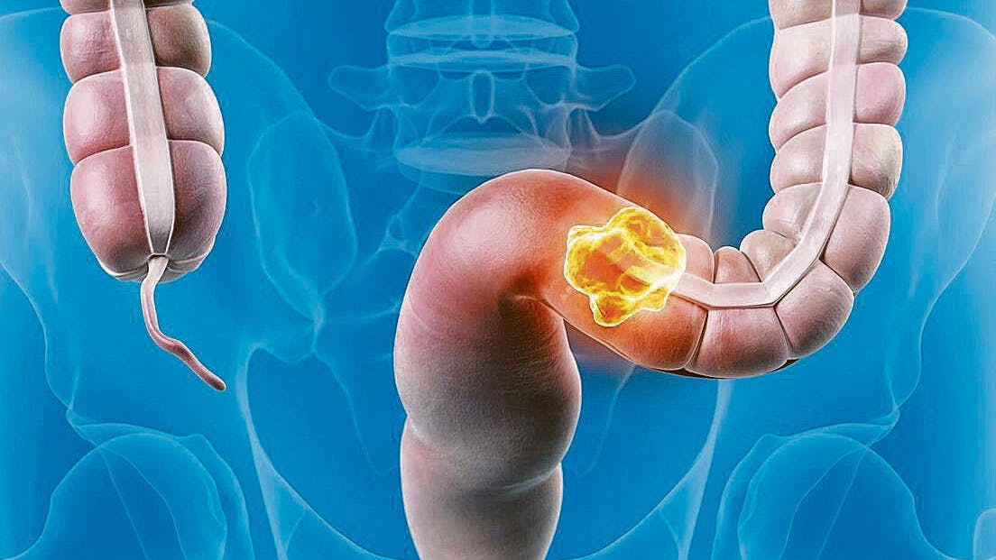 Zur Veranschaulichung: Die Grafik zeigt einen (sehr großen) Krebs im Darm.