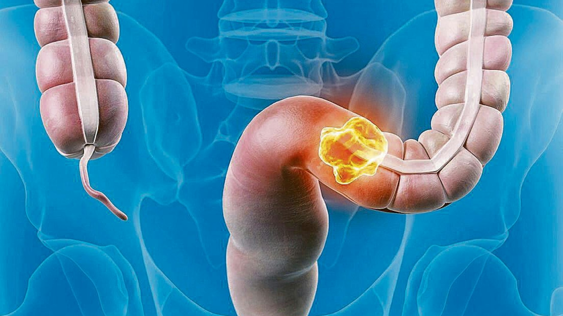 Zur Veranschaulichung: Die Grafik zeigt einen (sehr großen) Krebs im Darm.