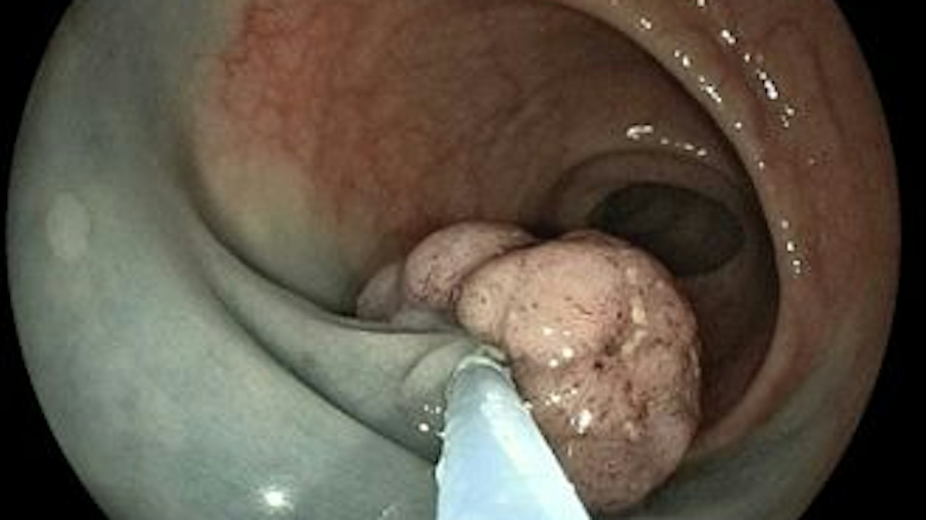 Blick durchs Koloskop: Mit einer Schlinge wird Darmkrebs im Frühstadium abgetragen.