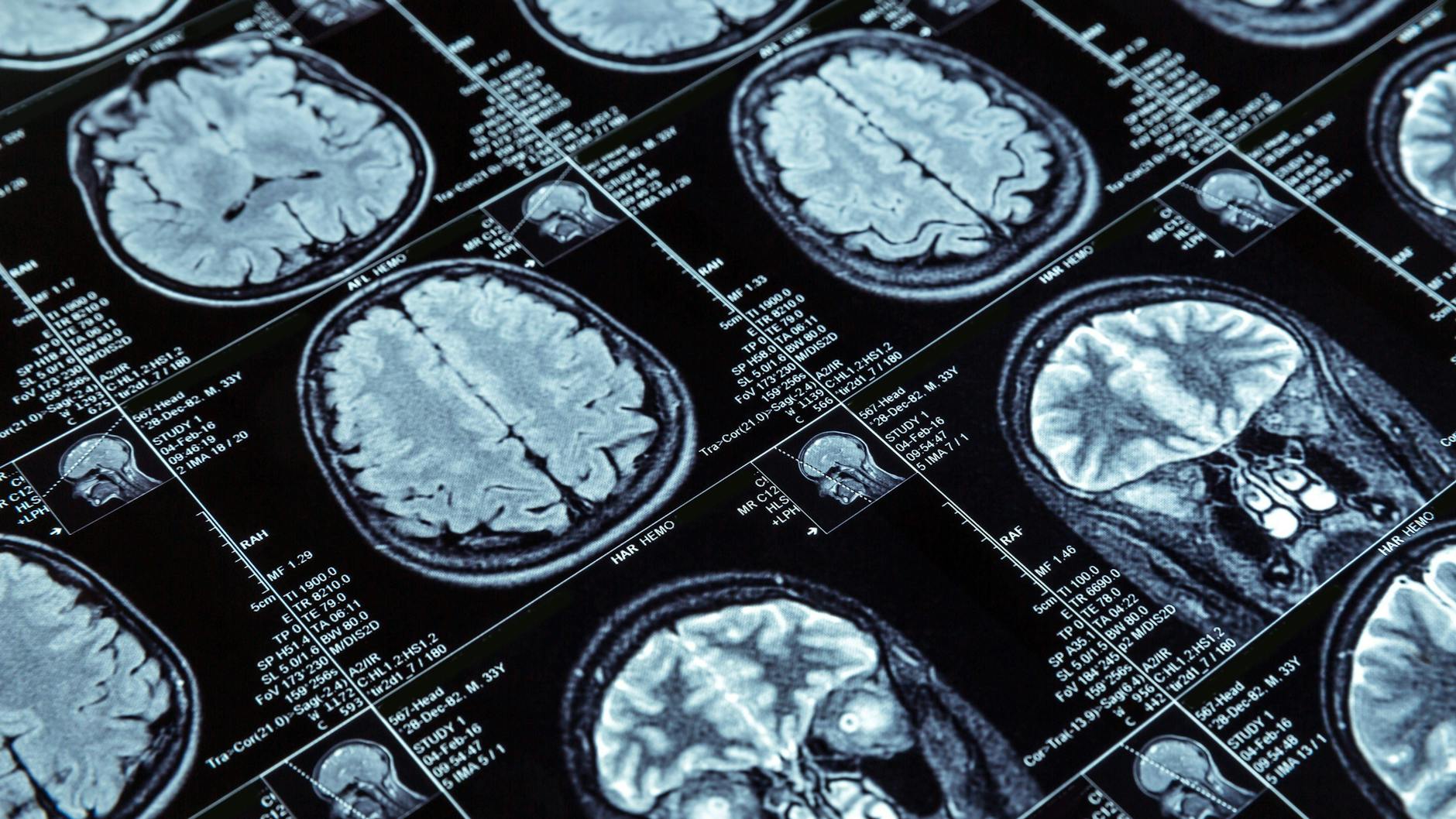Bei der chronisch-entzündlichen Erkrankung MS, die in Deutschland etwa 252.000 Menschen betrifft, zerstört das Immunsystem im Zentralen Nervensystem die schützenden Myelinhüllen.