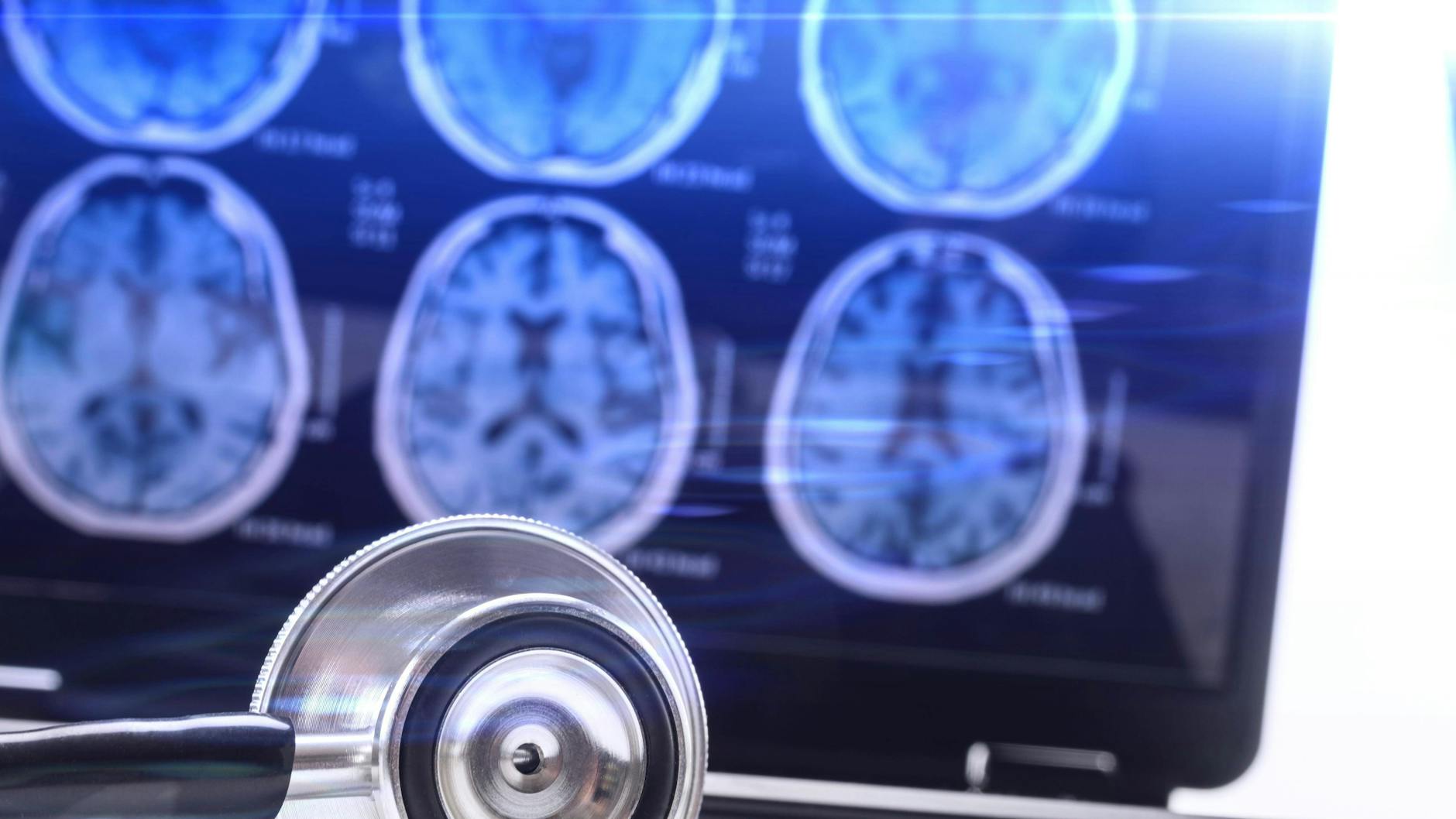 Bei der chronisch-entzündlichen Erkrankung MS greift das körpereigene Immunsystem die Nervenzellen sowie die schützende Isolierschicht der Nervenfasern (Myelin) an.