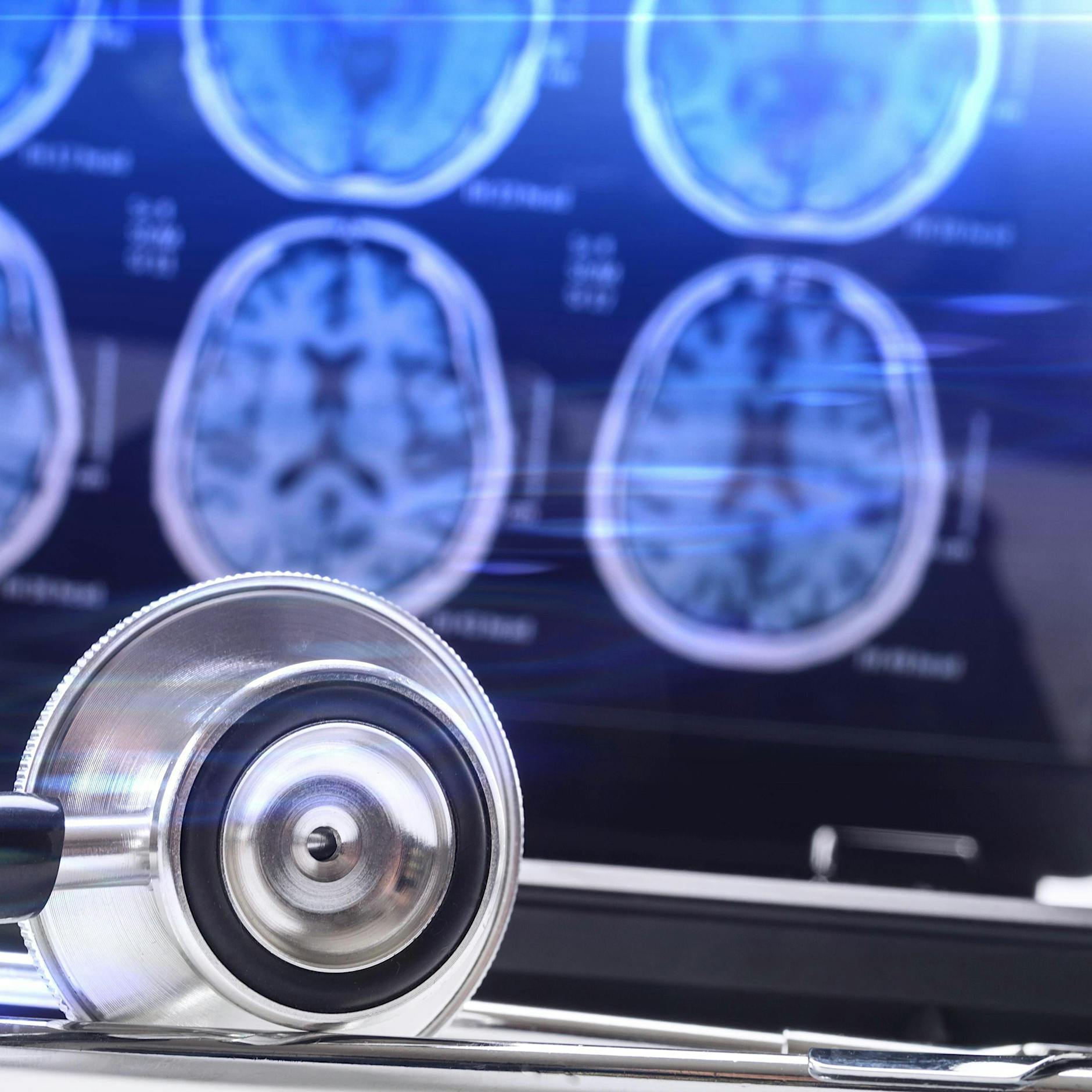 Was ein gängiges Herpesvirus mit der unheilbaren Krankheit MS zu tun hat