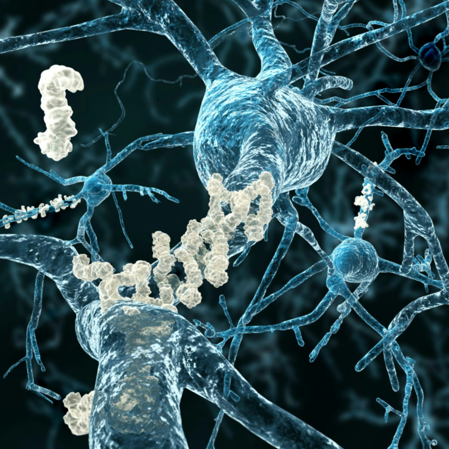 Neuronen, die von der Alzheimer-Krankheit betroffen sind