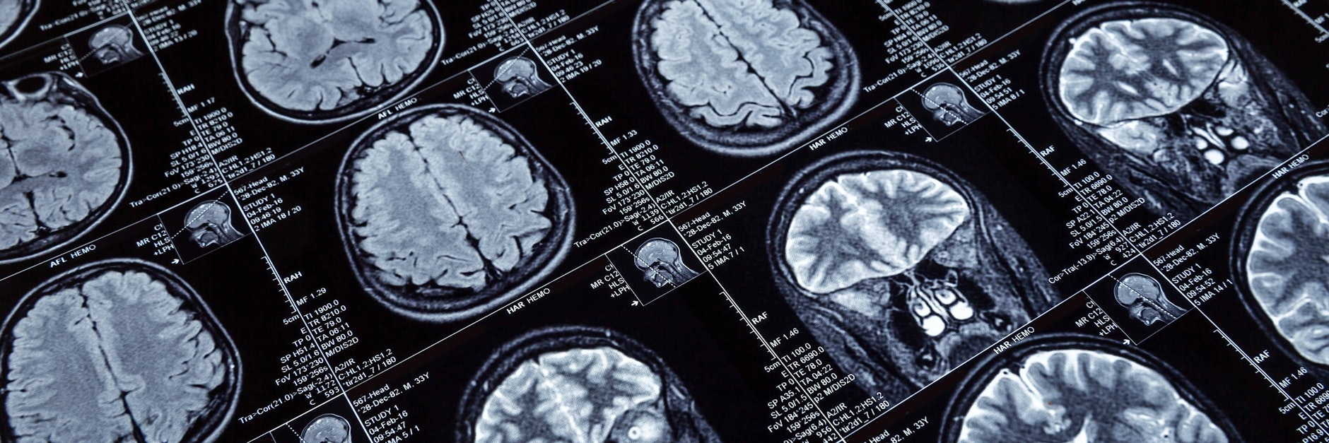 Computertomografie-Aufnahmen von einem Gehirn