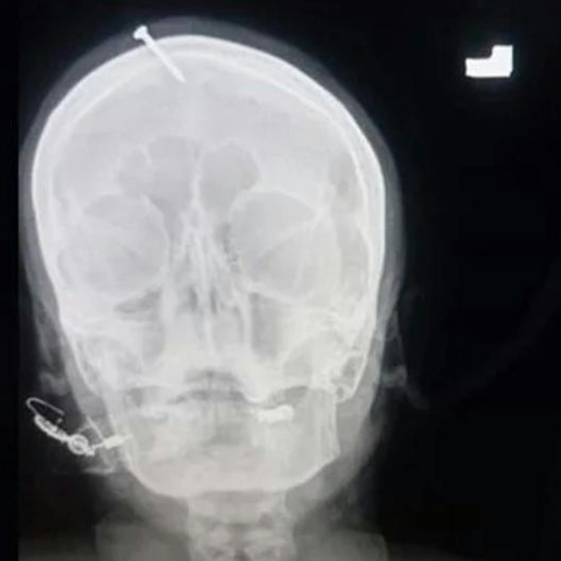 Wunderheiler schlägt Schwangerer Nagel in den Kopf - damit es ein Junge wird!