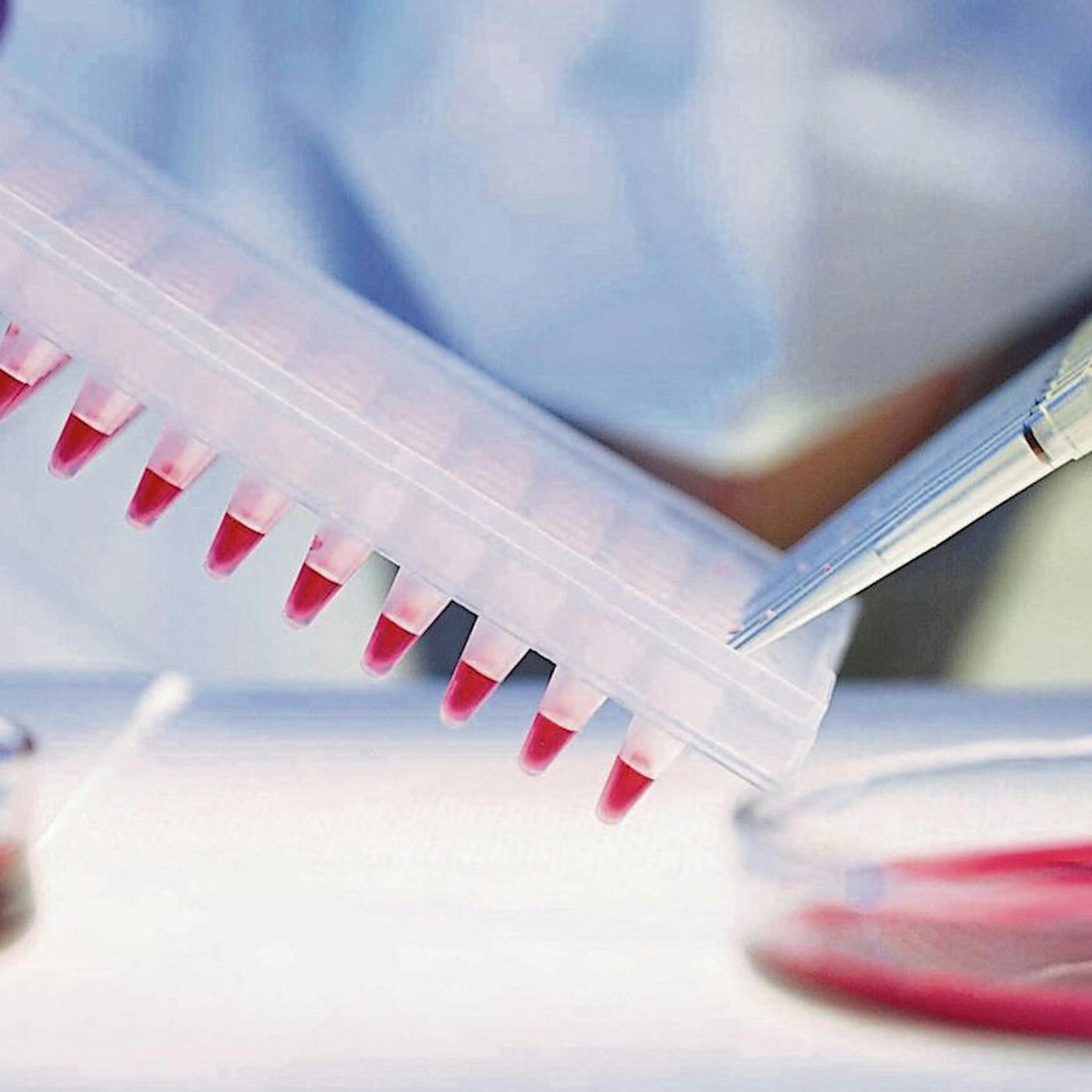 Erste Frau von HIV geheilt – nach Stammzelltransplantation