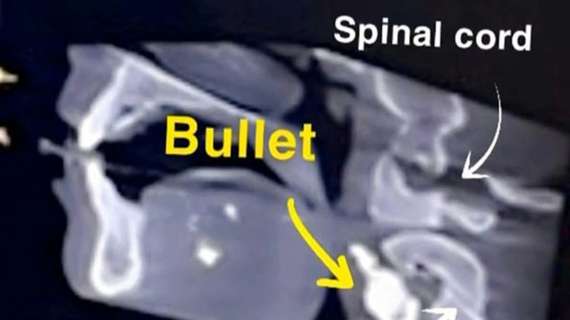 Der gelbe Pfeil zeigt die Kugel, die im Hals von Rodriguez steckt.