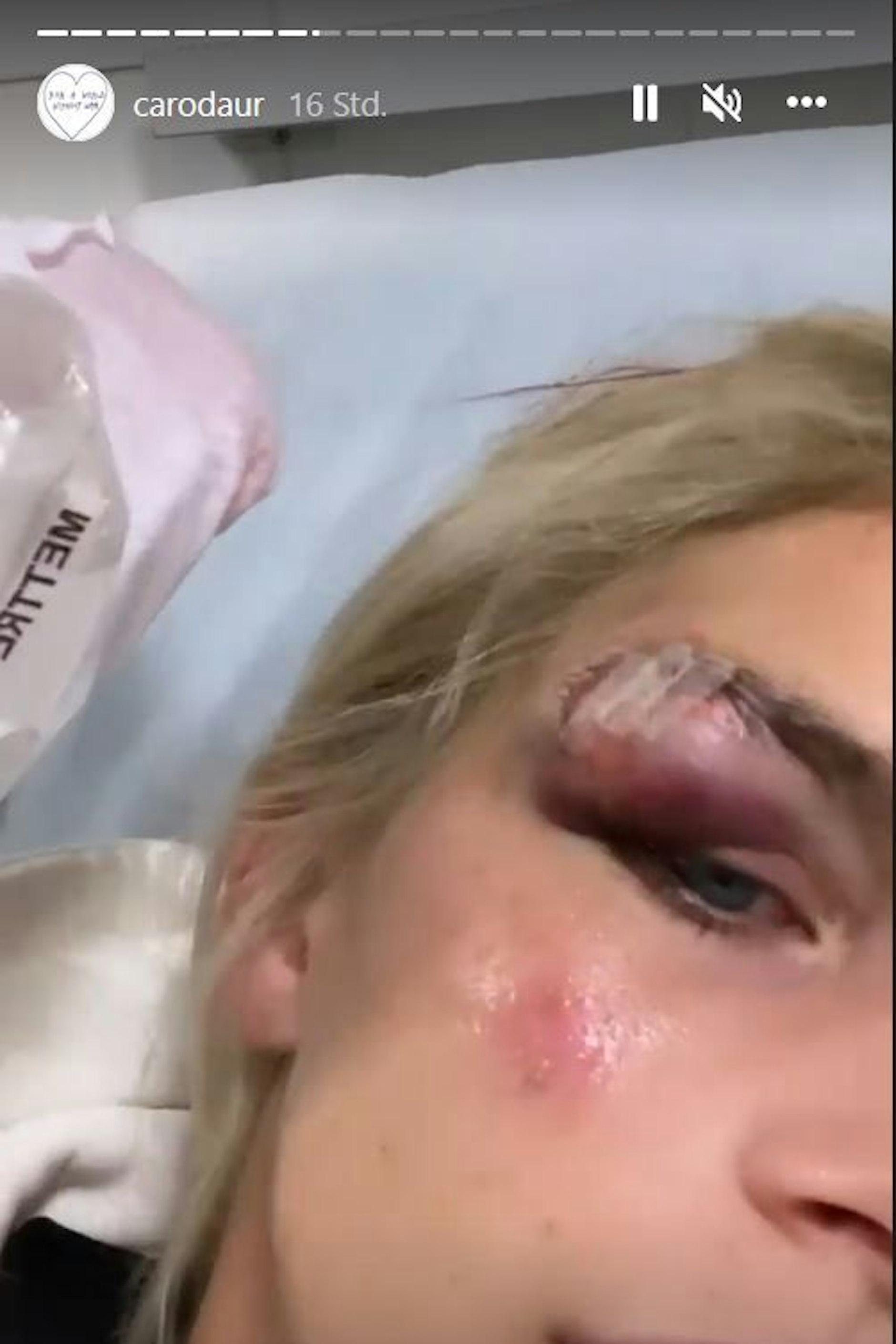 Caro Daur: Die Schwellung nimmt ihr die Sicht auf dem rechten Auge.