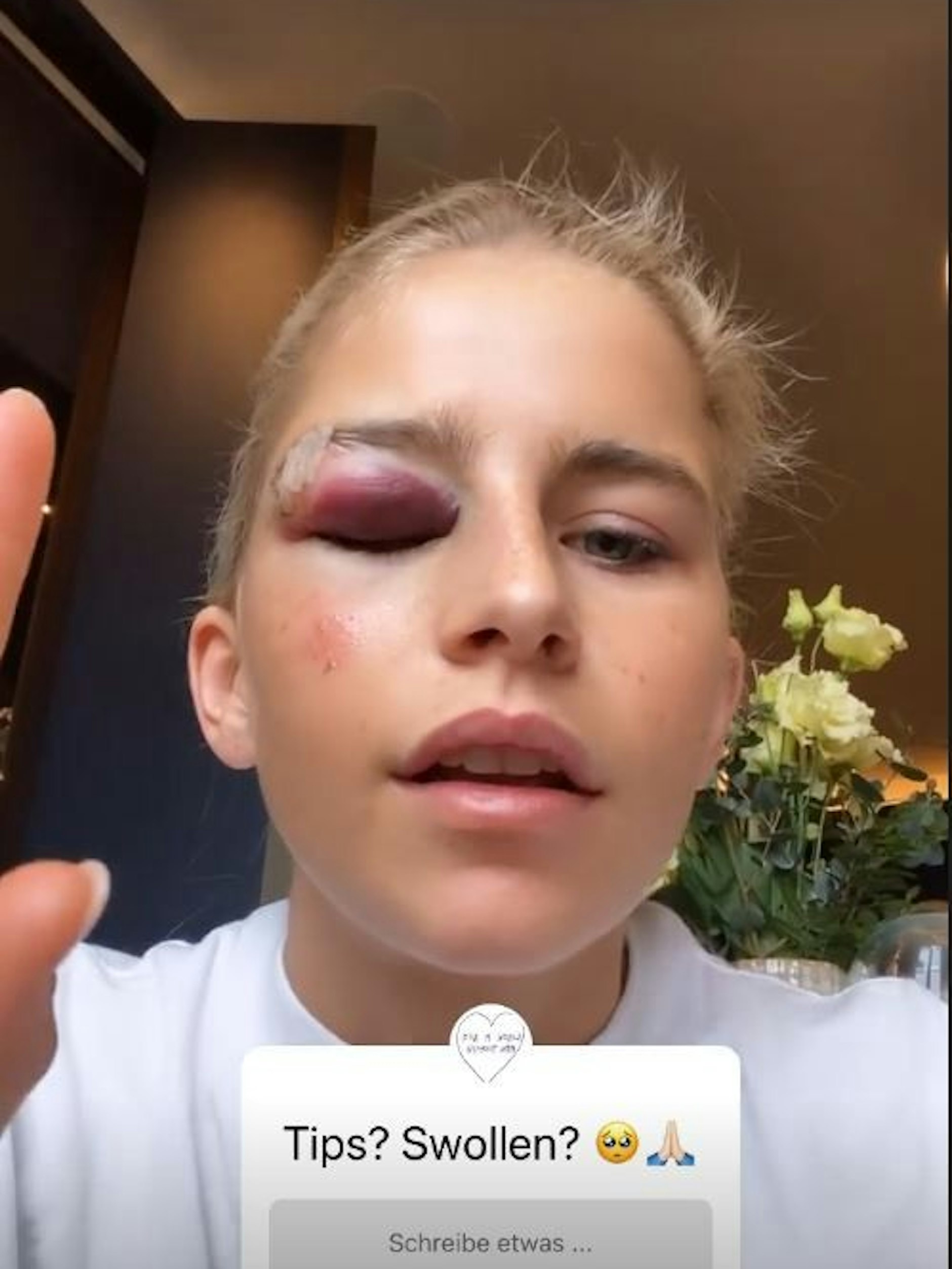 Nach der Behandlung konnte Caro Daur erstmal nicht mehr richtig sehen. 