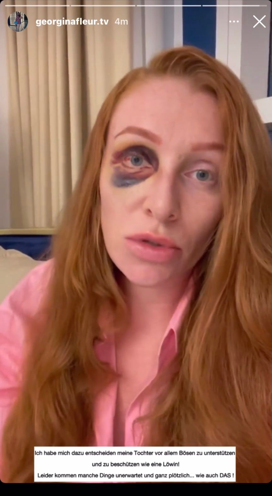 Image - Georgina Fleur brutal zusammengeschlagen: Hat ihr Ex Kubilay Özdemir sie so zugerichtet?