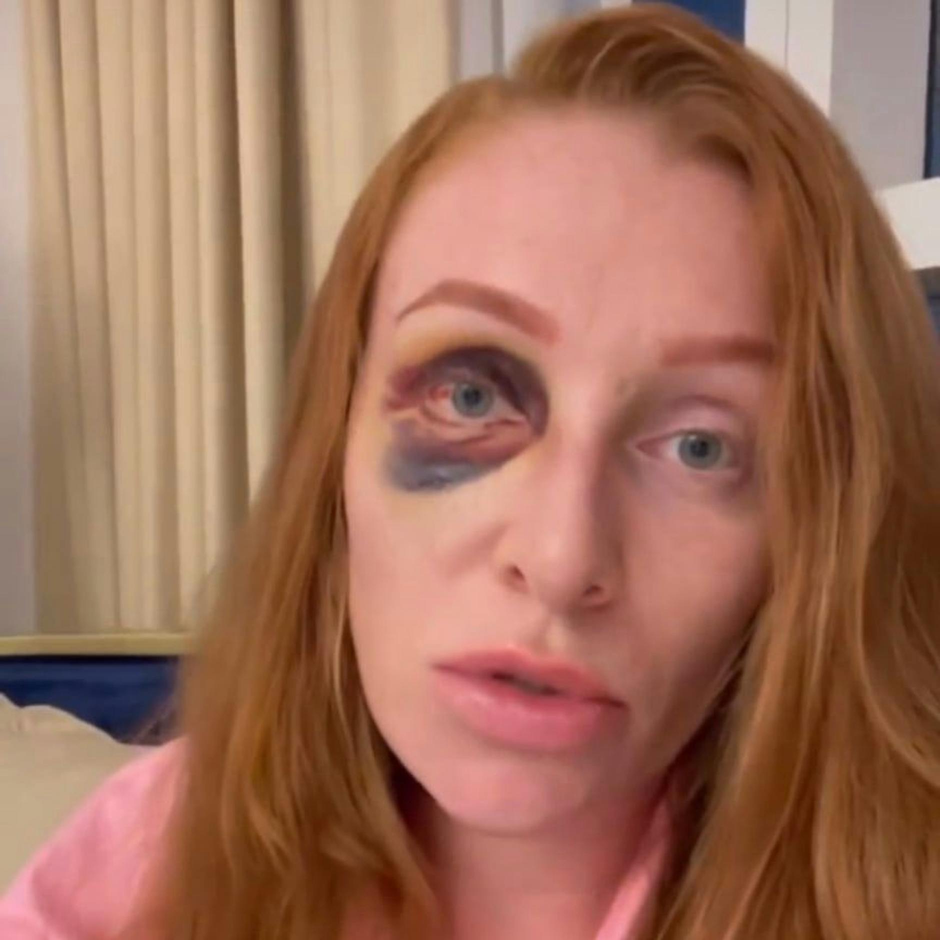 Georgina Fleur brutal zusammengeschlagen: Hat ihr Ex Kubilay Özdemir sie so zugerichtet?