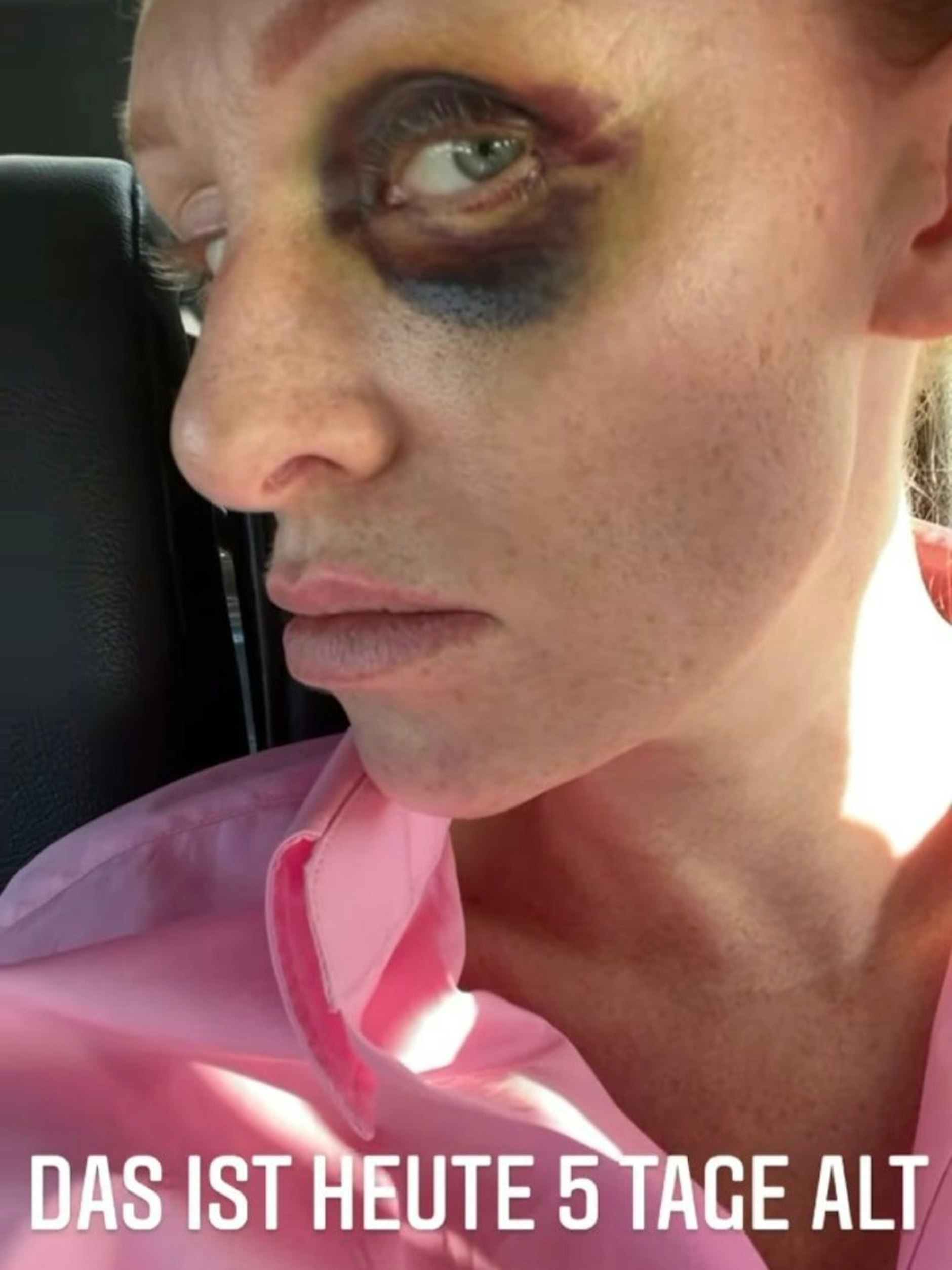 Georgina Fleur zeigt ihr blaues Auge.