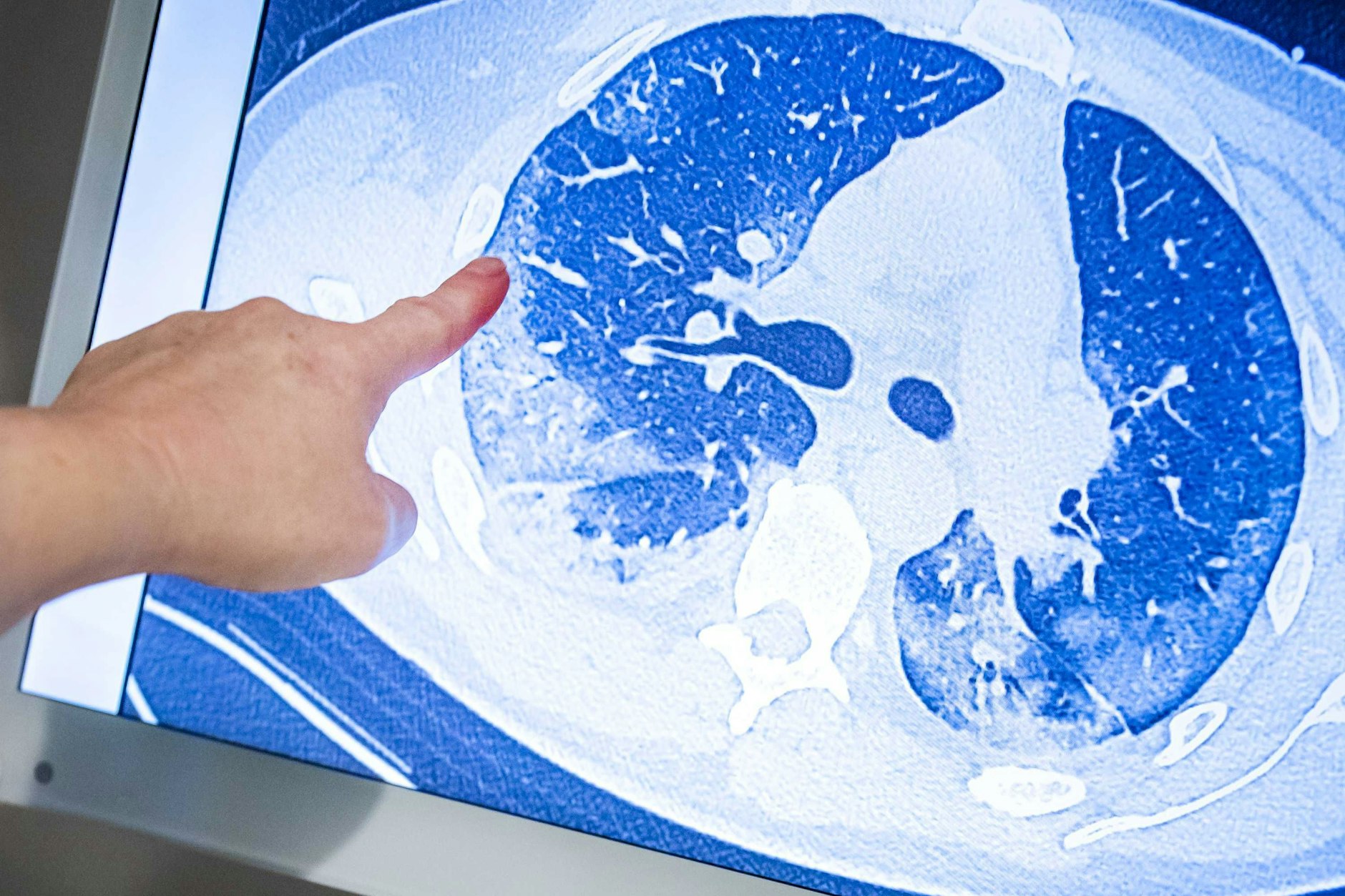 Ein behandelnder Arzt zeigt auf die CT-Aufnahme der Lunge eines Patienten, der sich mit dem Coronavirus infiziert hat.