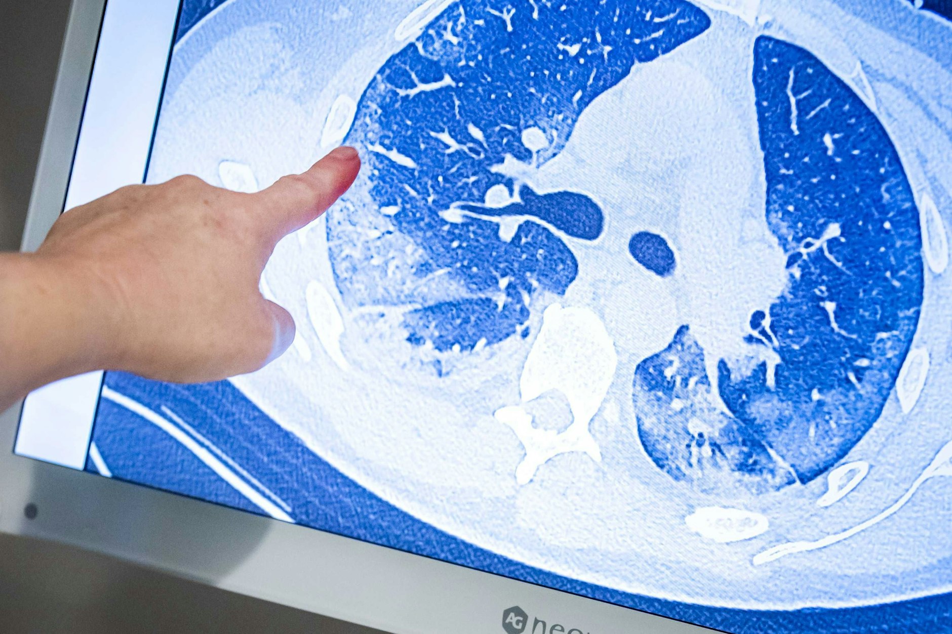 Ein behandelnder Arzt zeigt auf die CT-Aufnahme der Lunge eines Patienten, der sich mit dem Coronavirus infiziert hat.