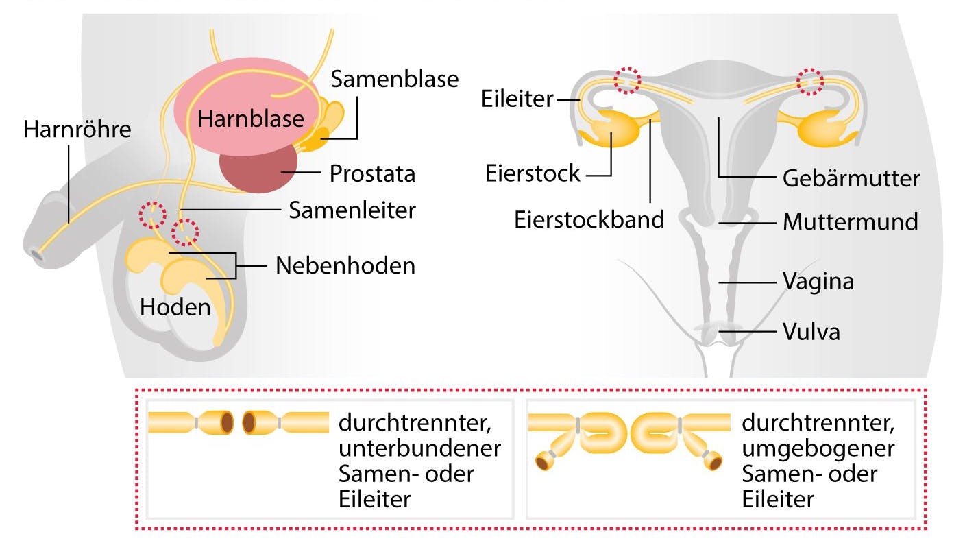Sterilisation bei Männern und Frauen und Männern