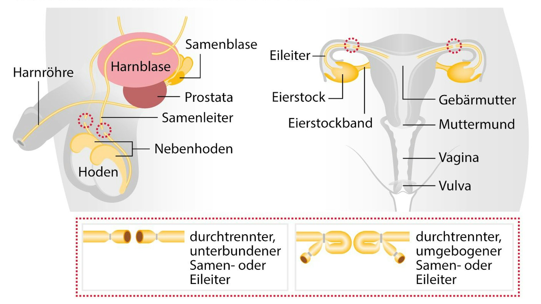 Sterilisation bei Männern und Frauen und Männern