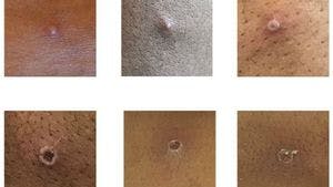 Das von der UK Health Security Agency (UKHSA) zur Verfügung gestellte Bild zeigt Hautläsionen bei Patienten, bei denen Affenpocken nachgewiesen wurden.