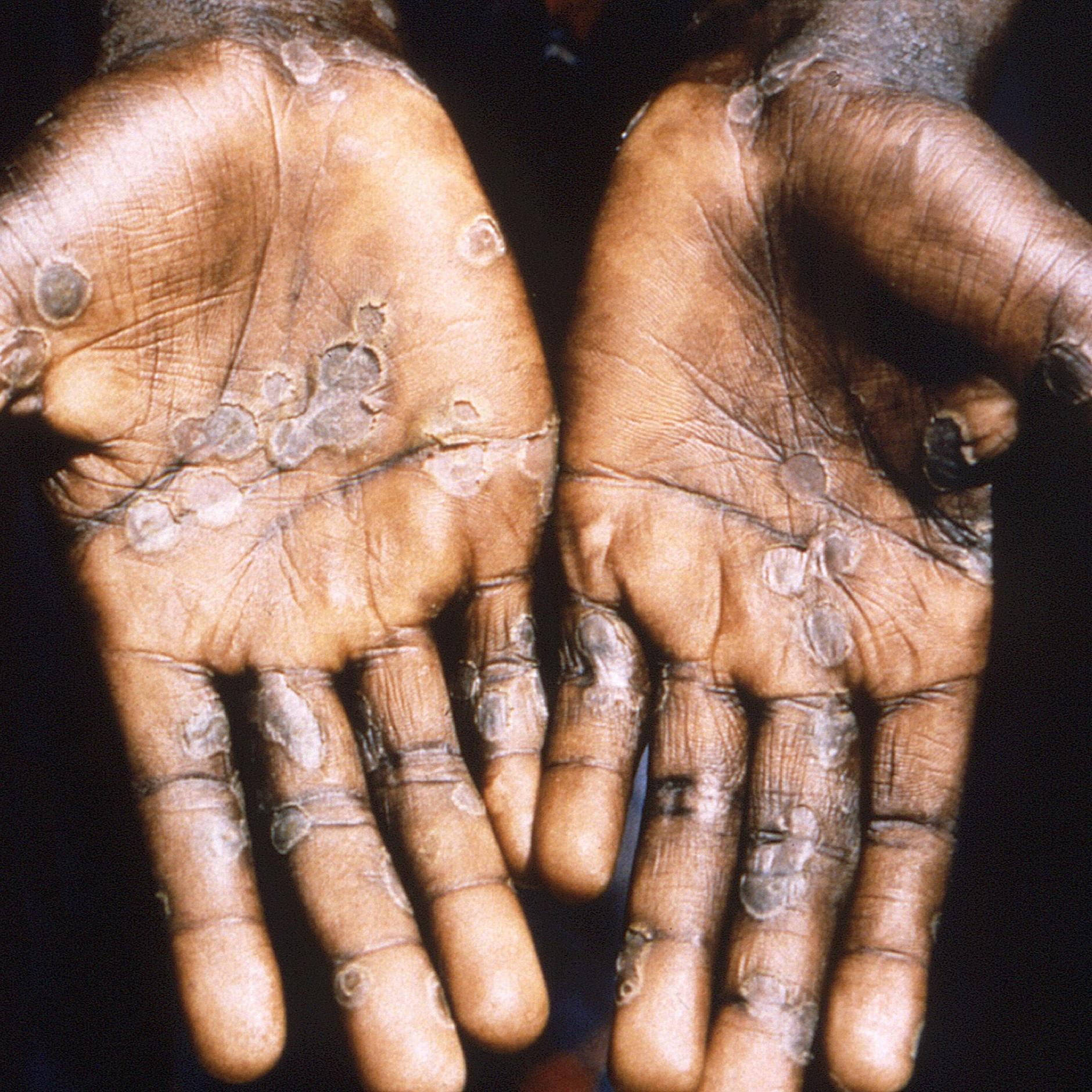 Affenpocken bald in Deutschland? RKI warnt vor Verbreitung