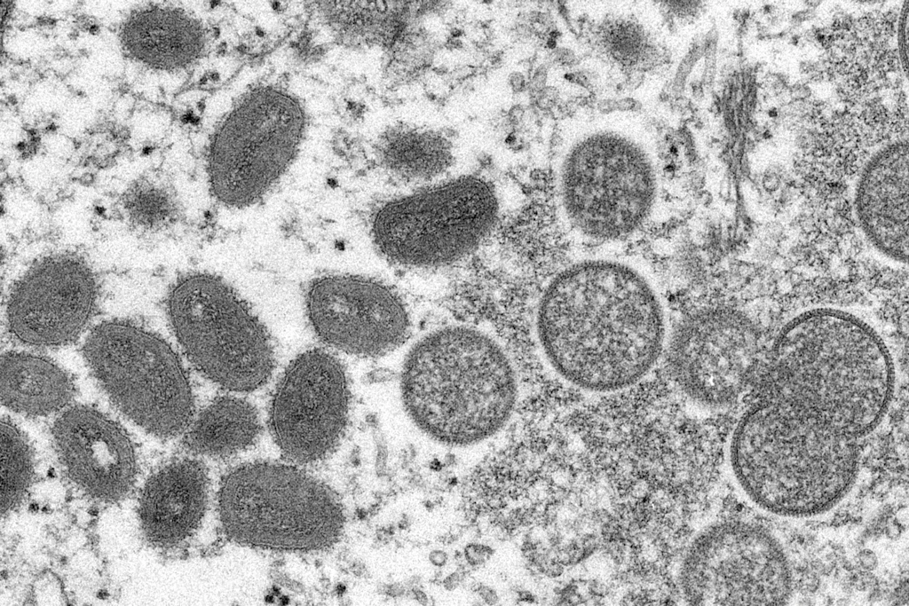 Update! Affenpocken-Virus: Ausbrüche auf Fetisch-Festival und in Sauna-Club! DIESE Gruppe ist besonders gefährdet