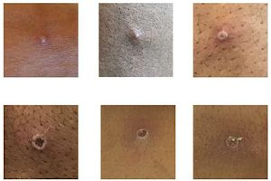 Die Bilder zeigen Hautläsionen bei Patienten, bei denen Affenpocken nachgewiesen wurden.