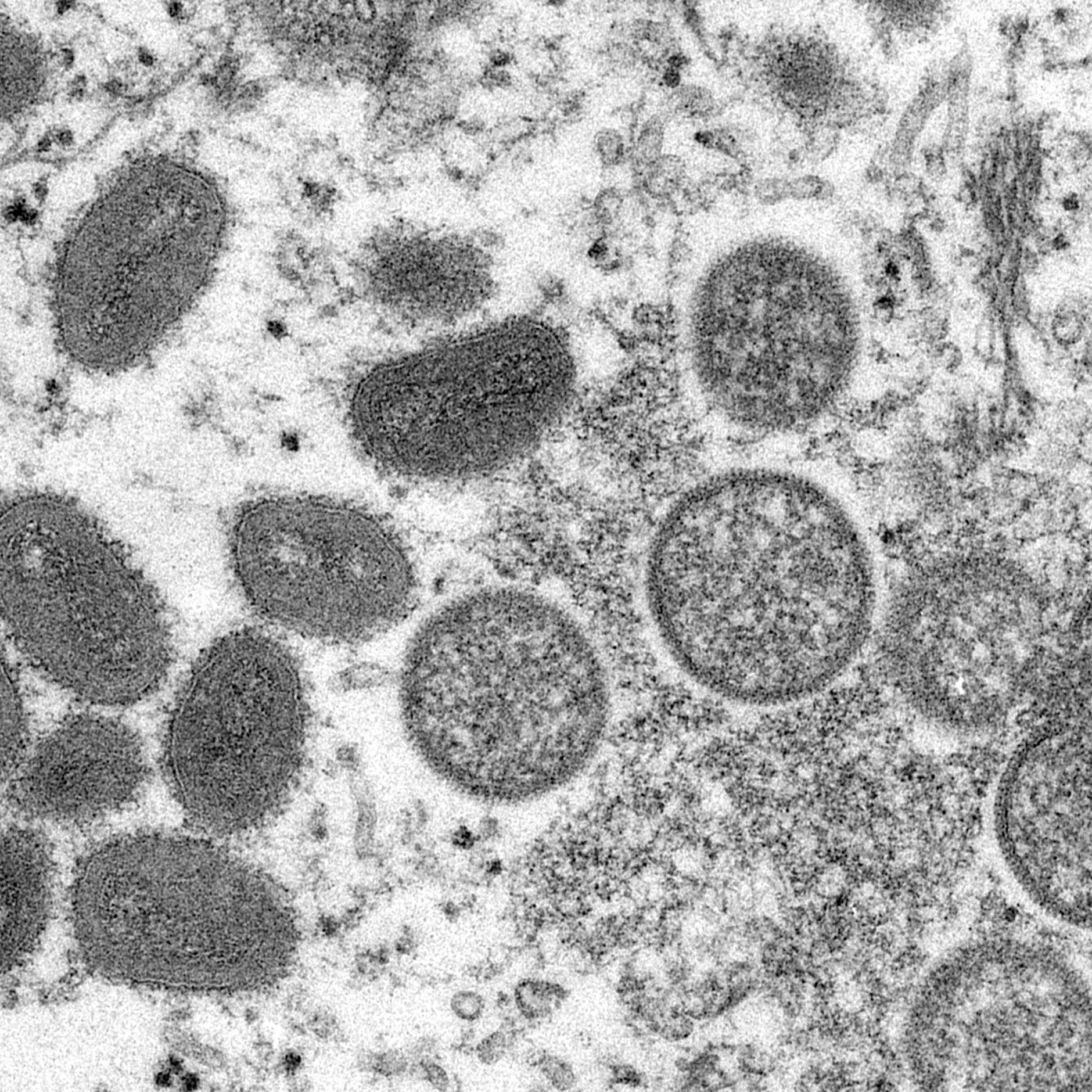 Affenpocken: Dritter Fall in Berlin, sechs Fälle bundesweit