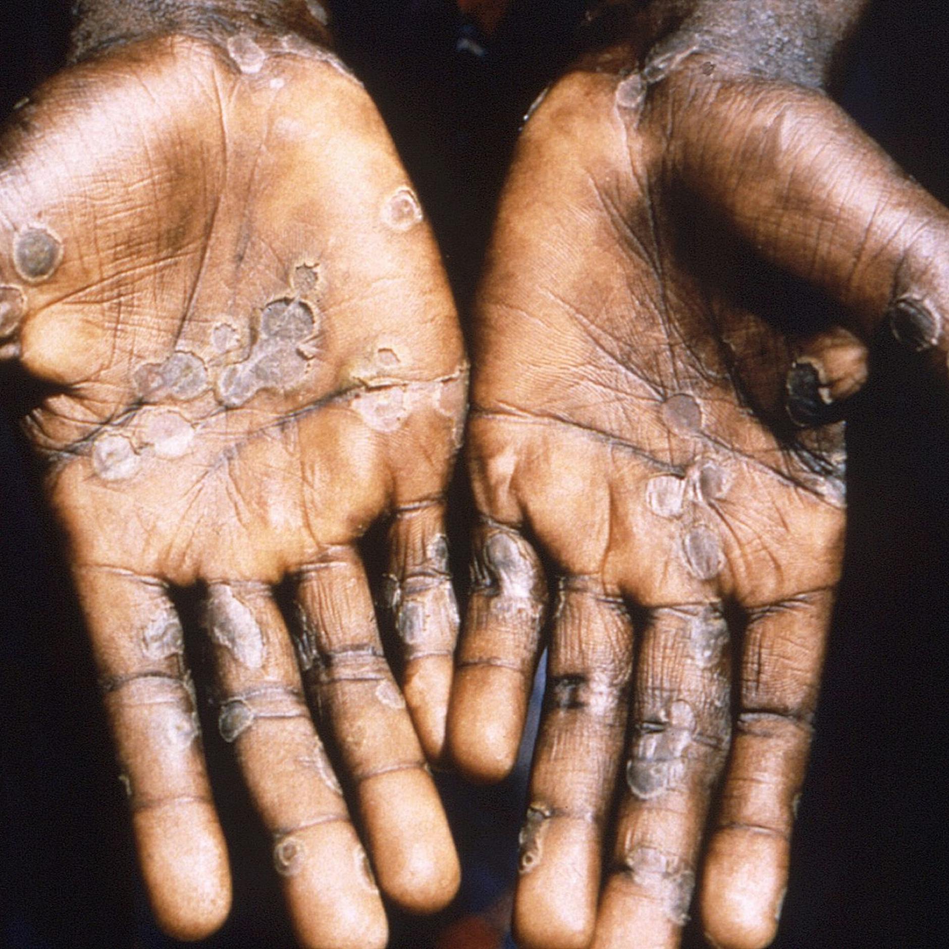 Neuer Name: Affenpocken werden ab sofort Mpox genannt