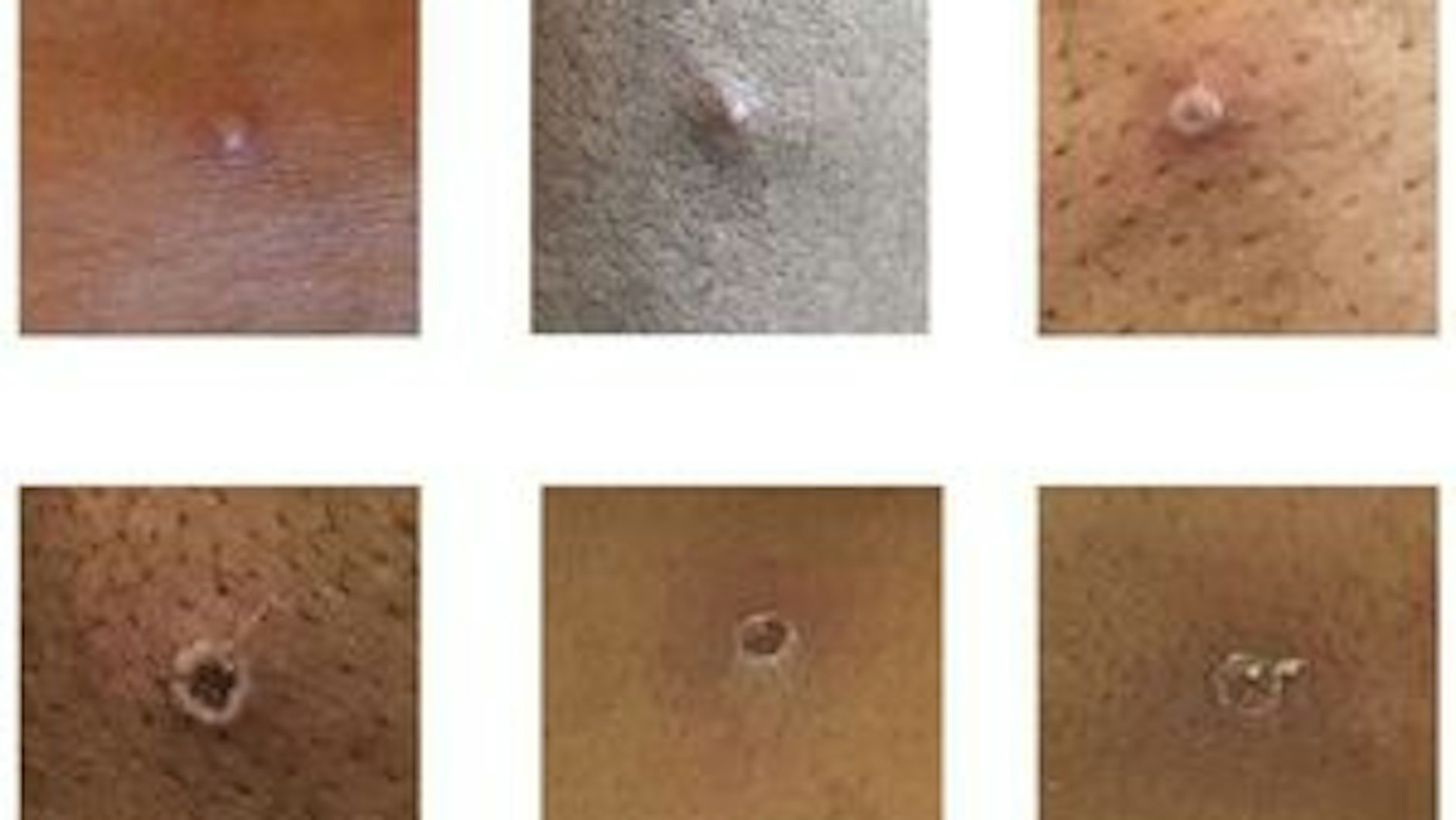 Das von der UK Health Security Agency (UKHSA) zur Verfügung gestellte Bild zeigt Hautläsionen bei Patienten, bei denen Affenpocken nachgewiesen wurden.