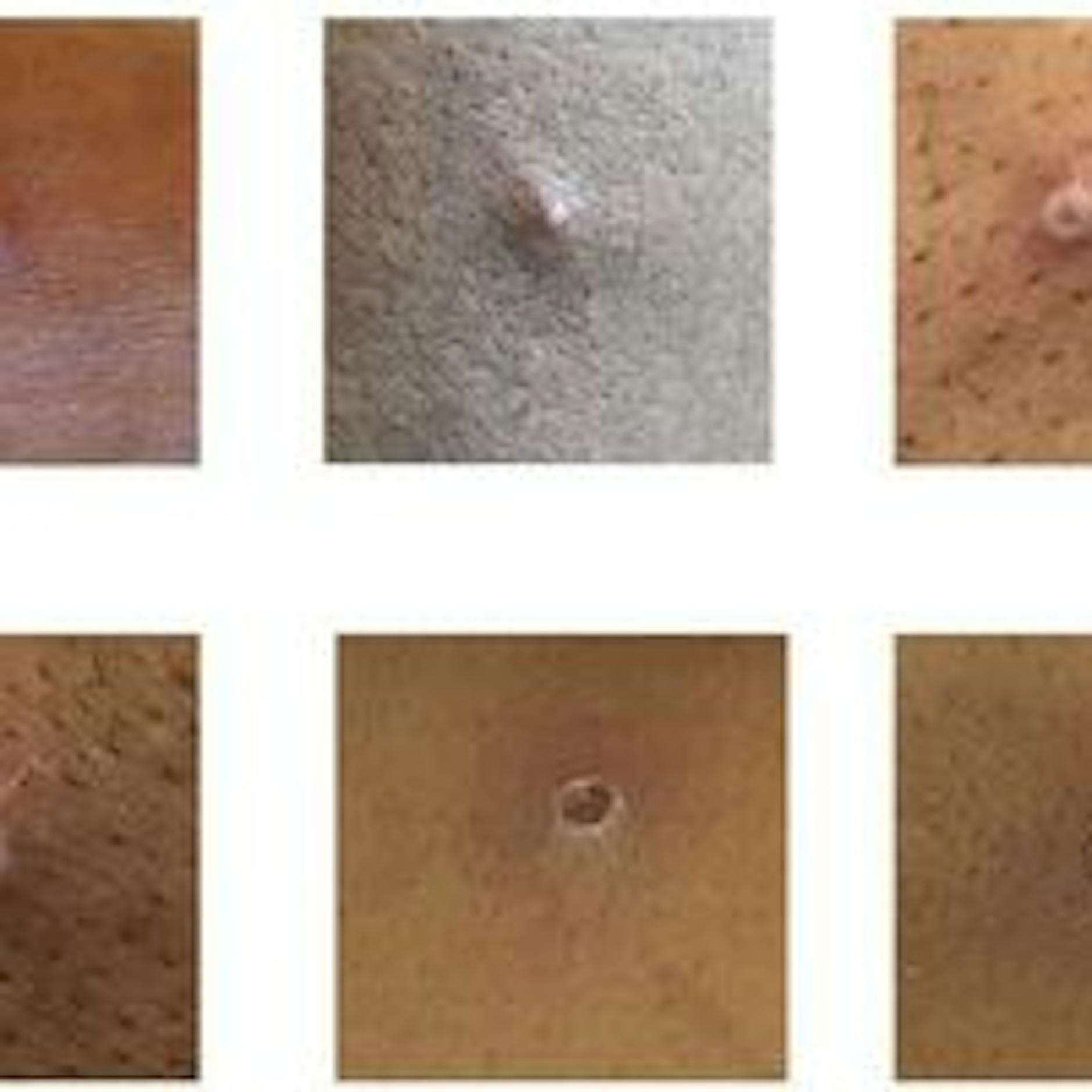 Schluss mit der Affenpocken-Panik! Sorge von Eltern um Kinder ist unbegründet