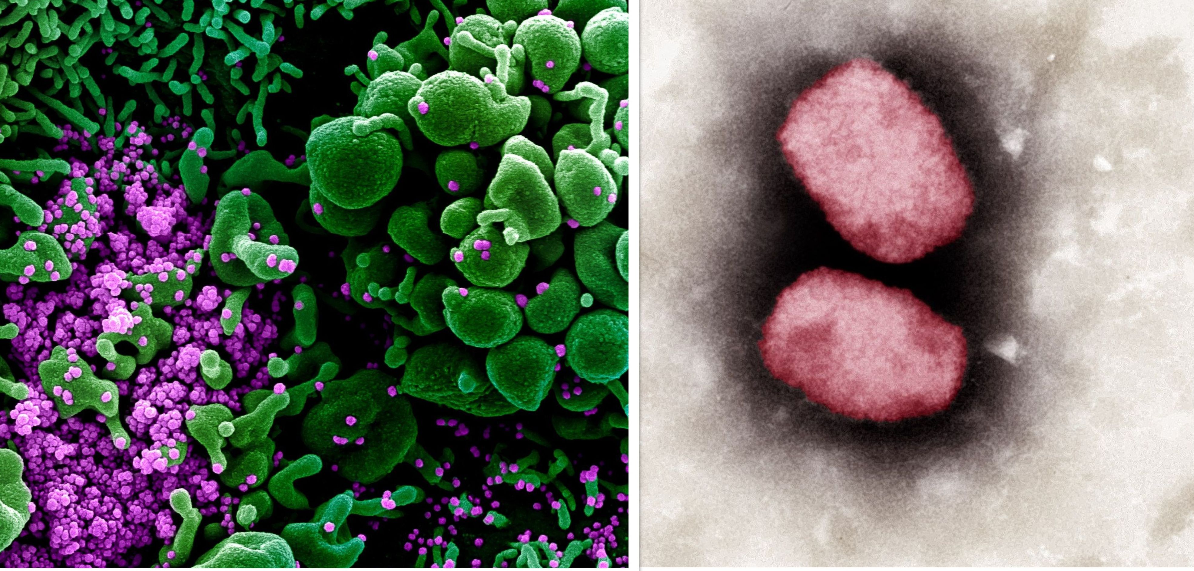 So unterscheidet sich Corona von Affenpocken – und das haben die beiden Erreger gemeinsam!