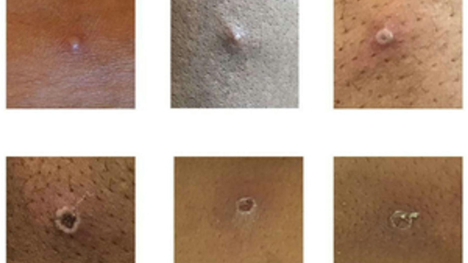 Die Bilder zeigen Hautläsionen von Affenpocken.