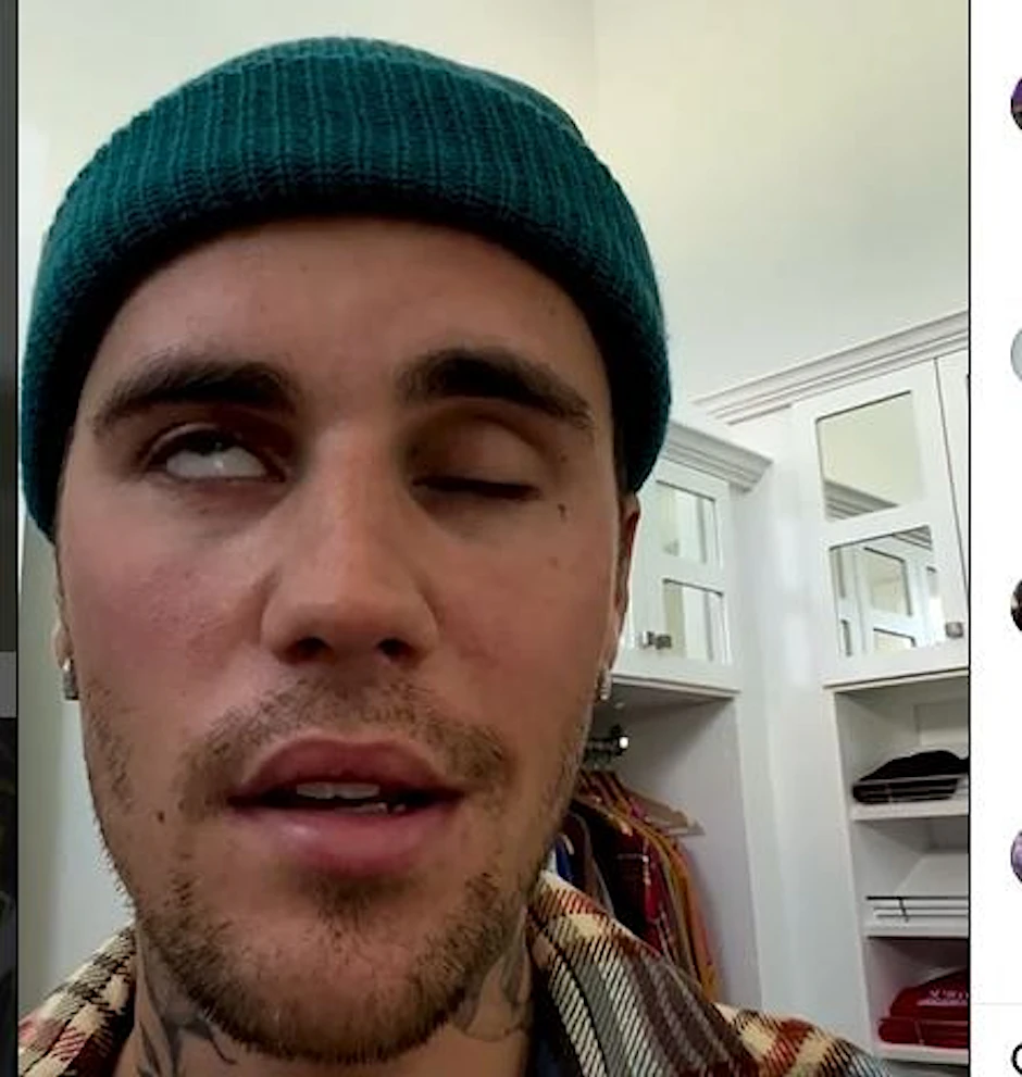 Justin Bieber leidet an Gesichtslähmung.