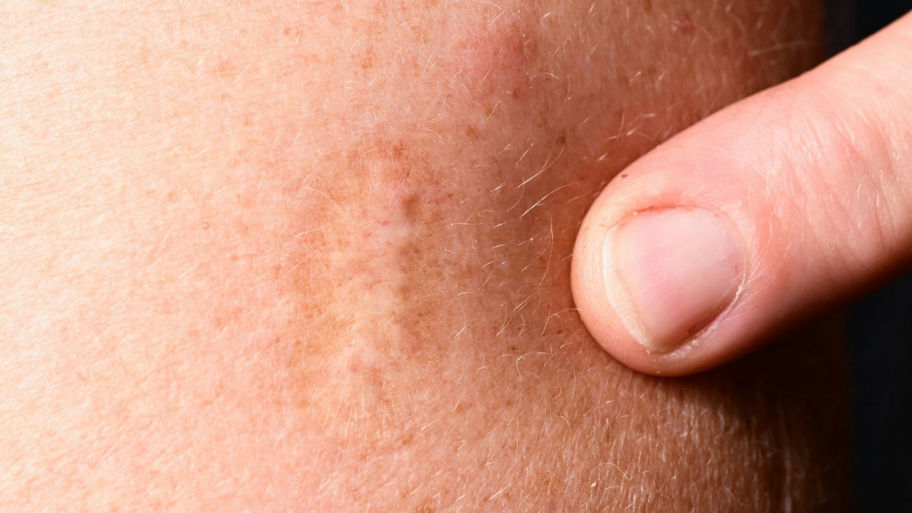 Viele ältere Menschen haben noch eine solche Narbe von der Pockenimpfung am Oberarm.