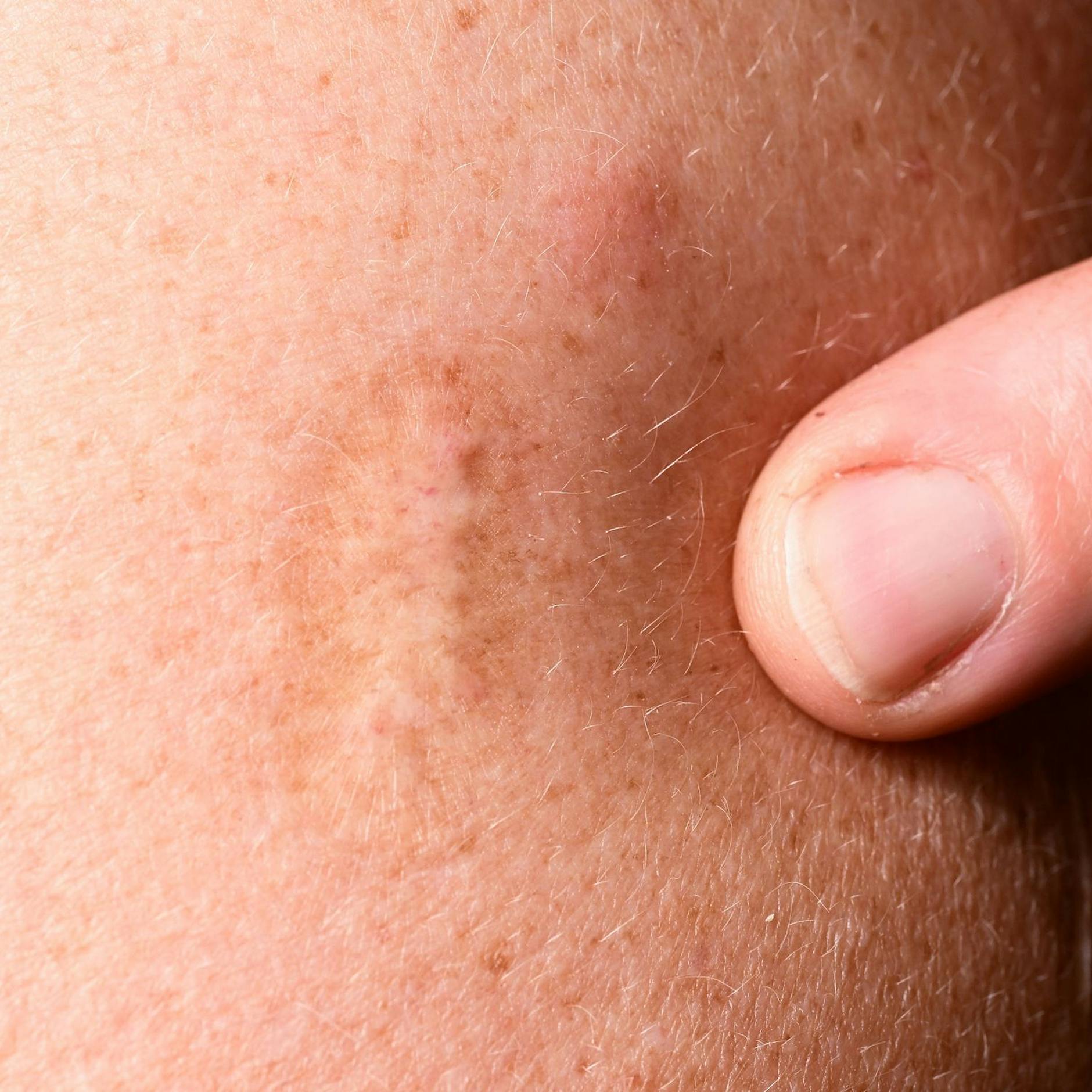 WHO: Pockenimpfung gegen Affenpocken zu 85 Prozent wirksam