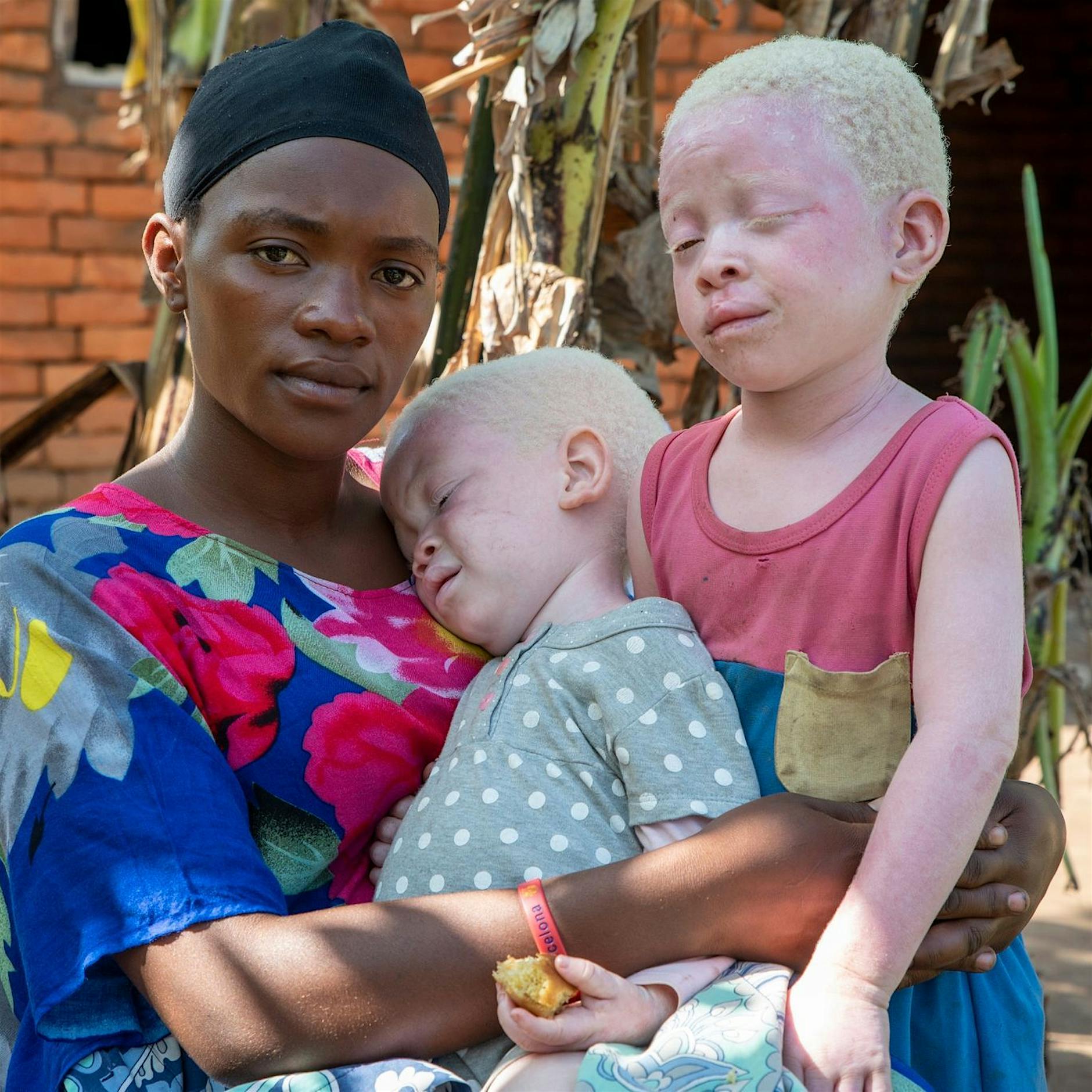 Aberglaube und Ausgrenzung: Albinismus bleibt ein Stigma